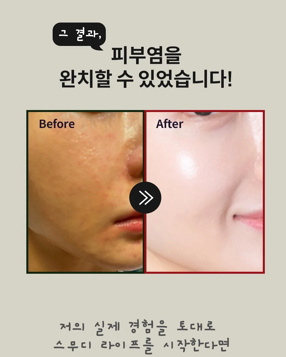 토퍼 11