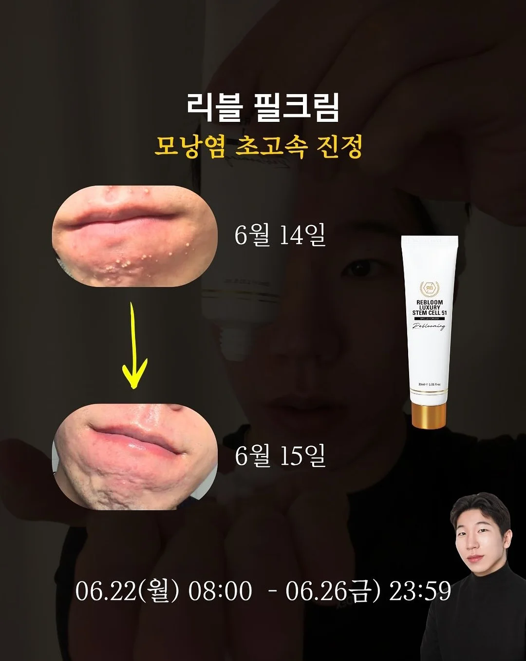 배럴 래쉬가드 1