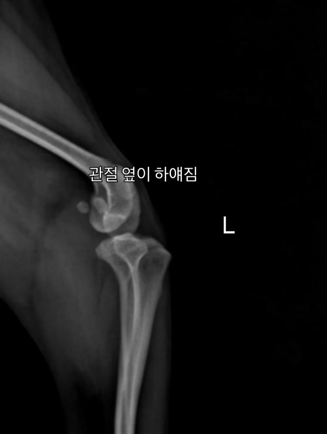 복직근이개 회복 산후복대 3