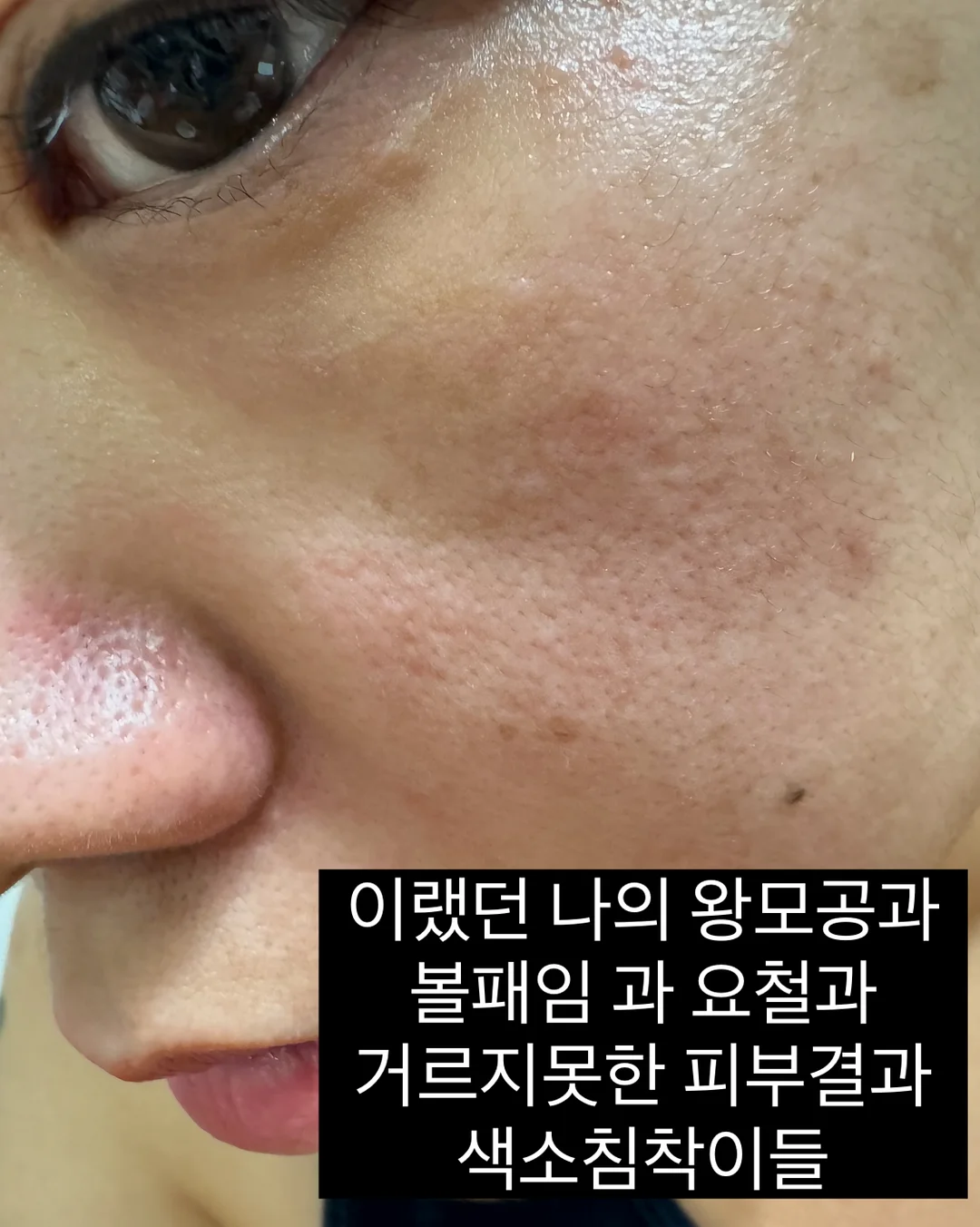 멜리사 M러버 스트라이프 샌들 4