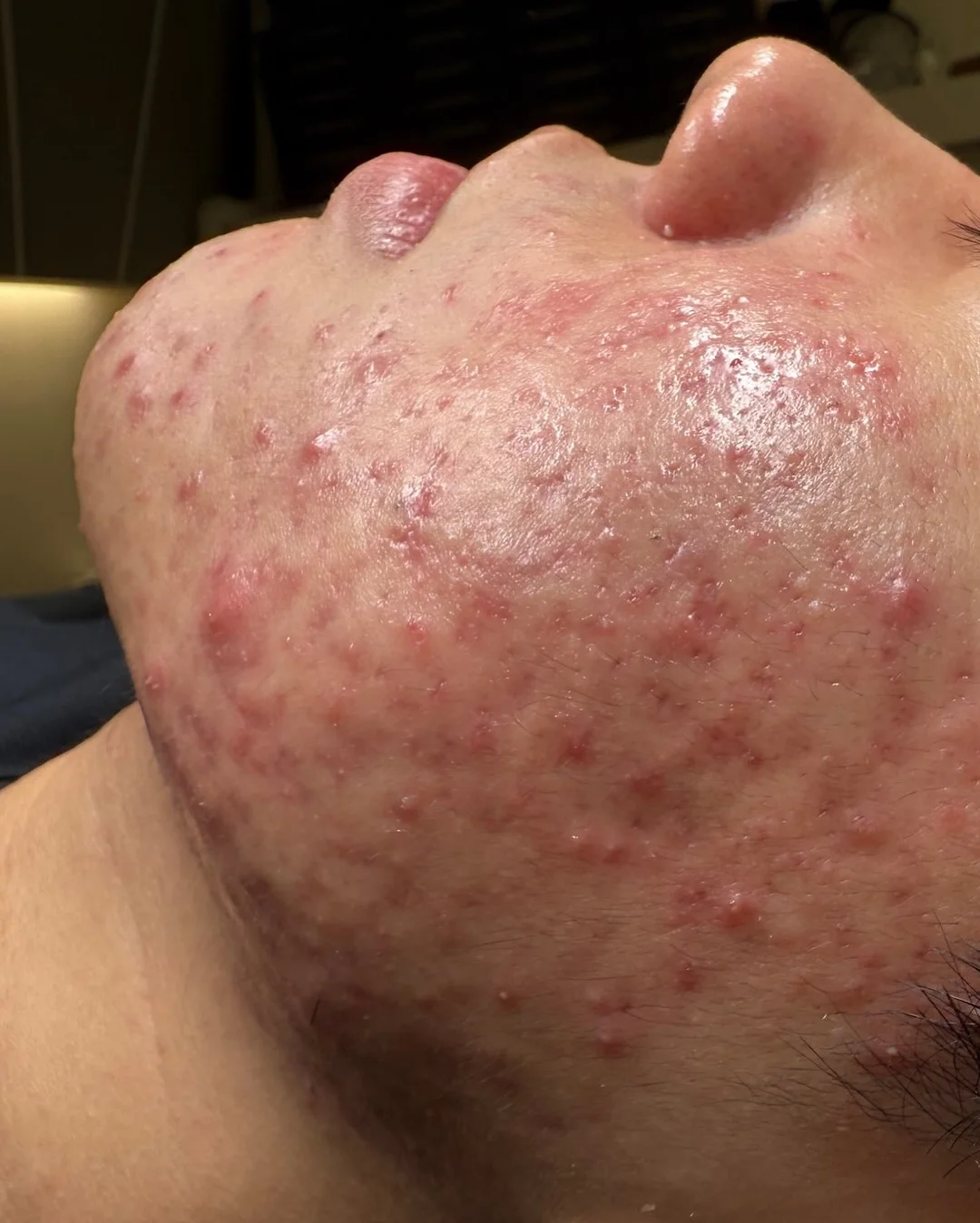 모기패치 12