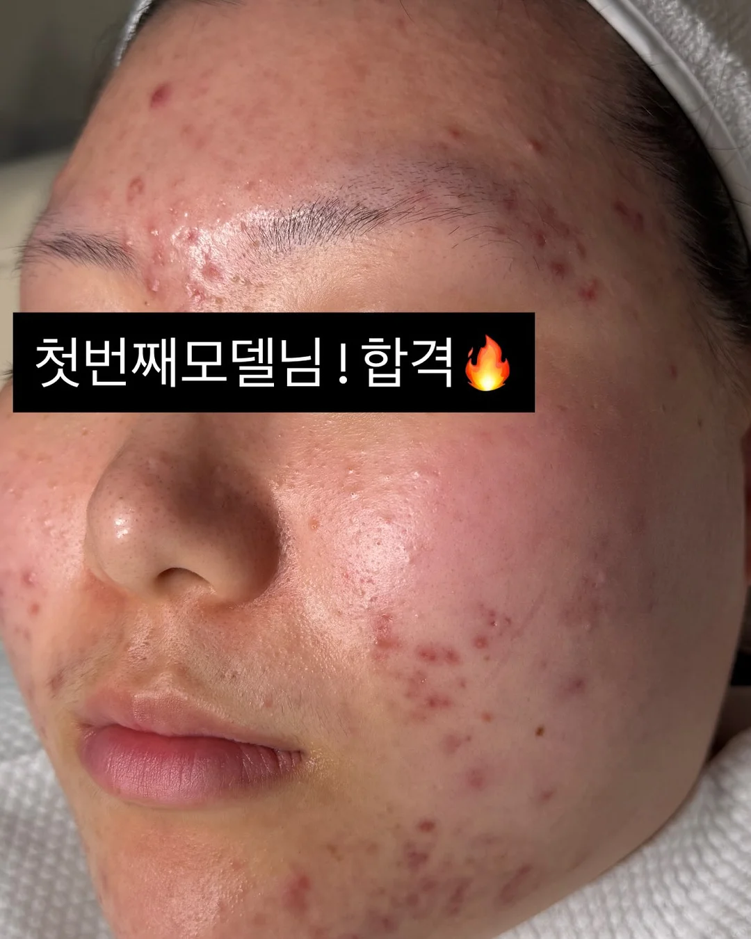 모기패치 14