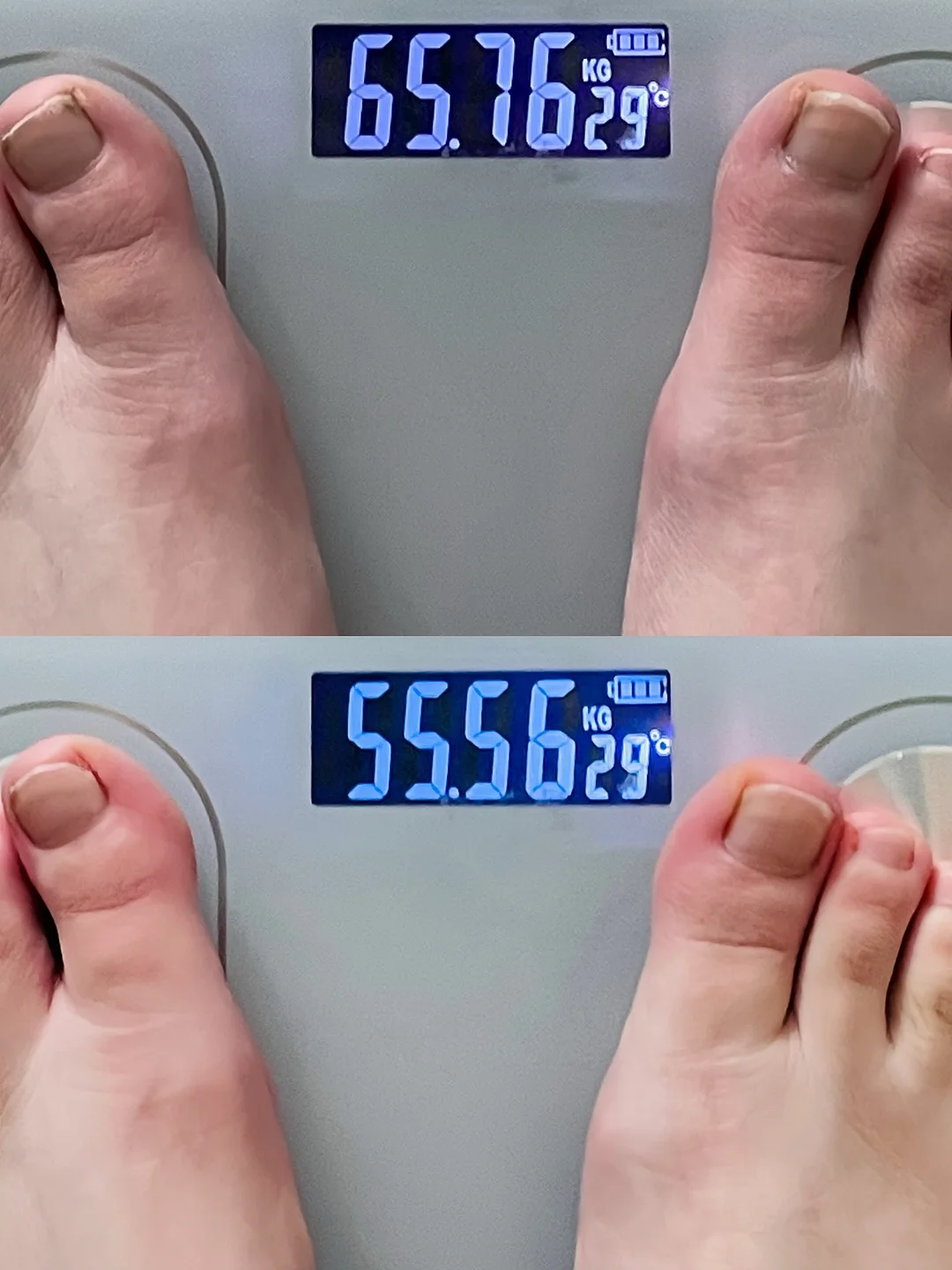 여드름 압출 홈 케어 1