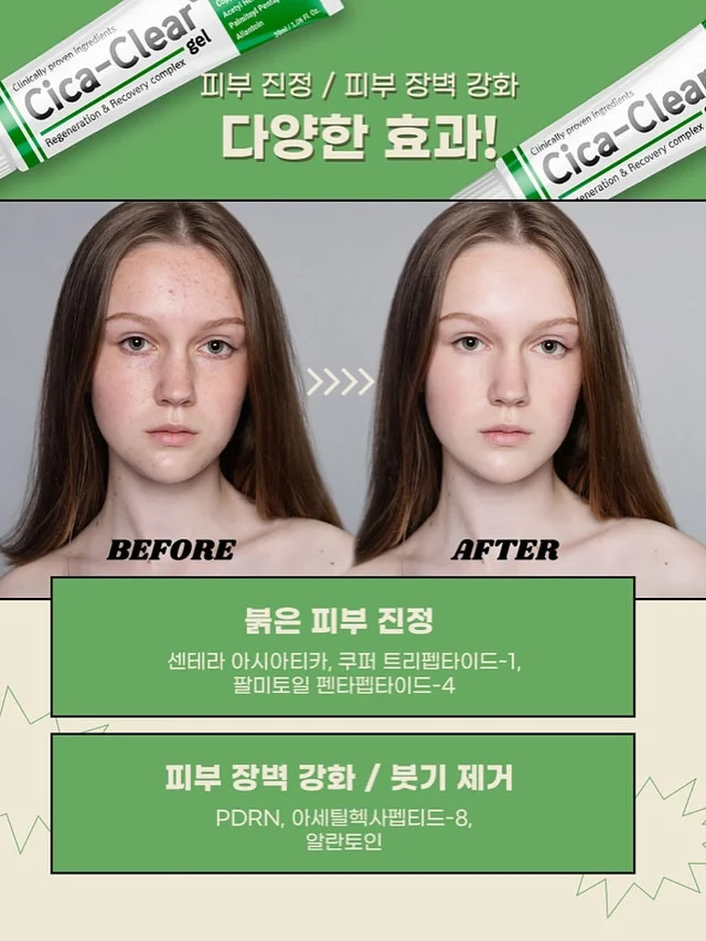 측두근 상부승모근 관리 6