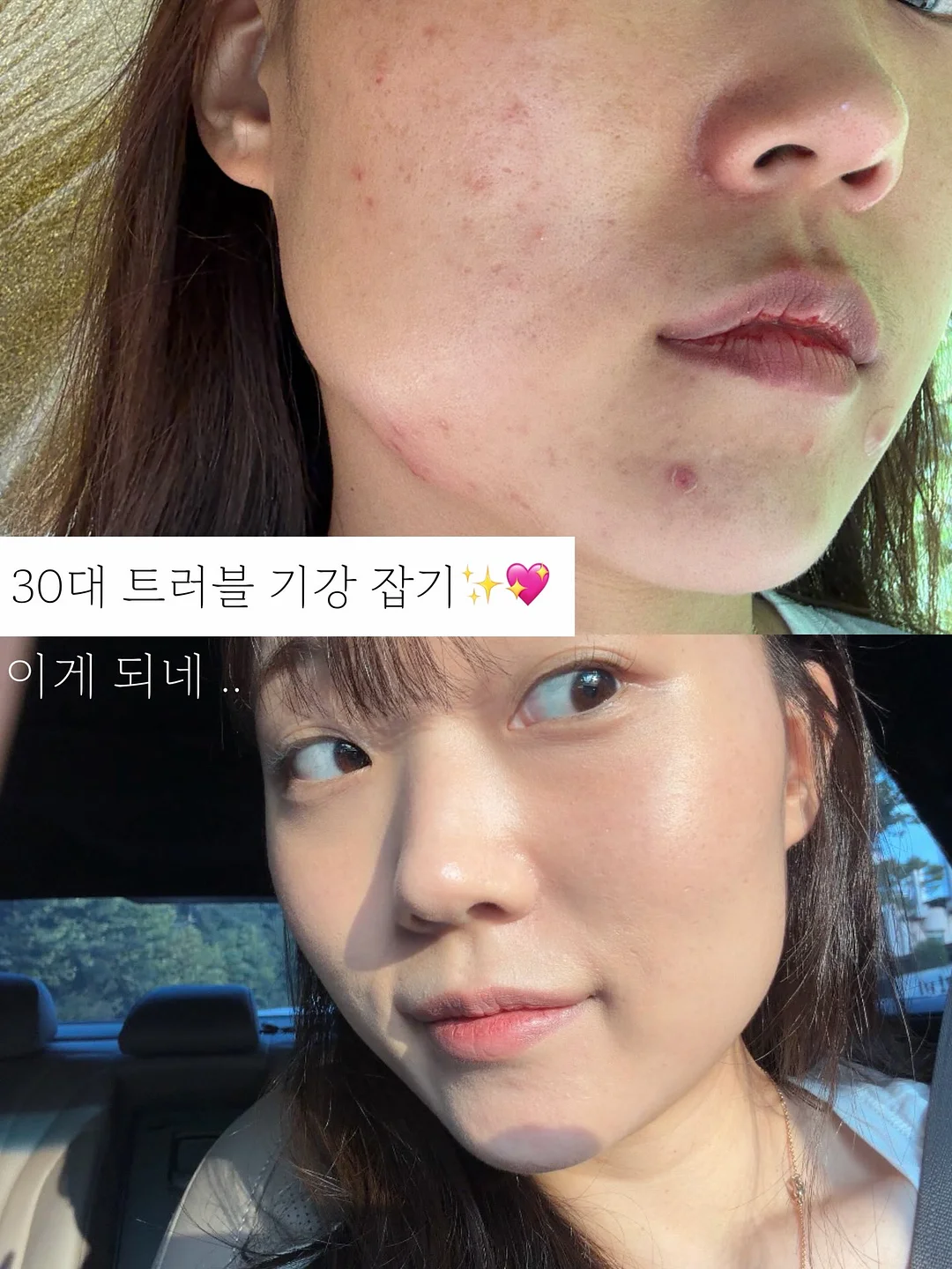 입술 문신 시술 1