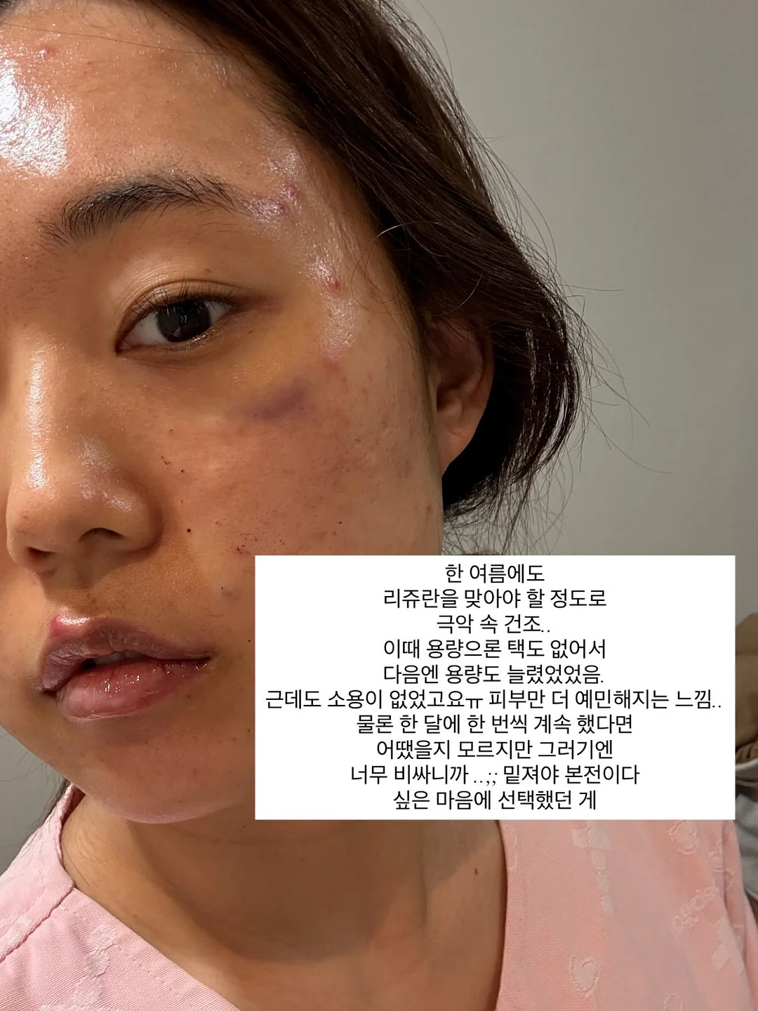 입술 문신 시술 11