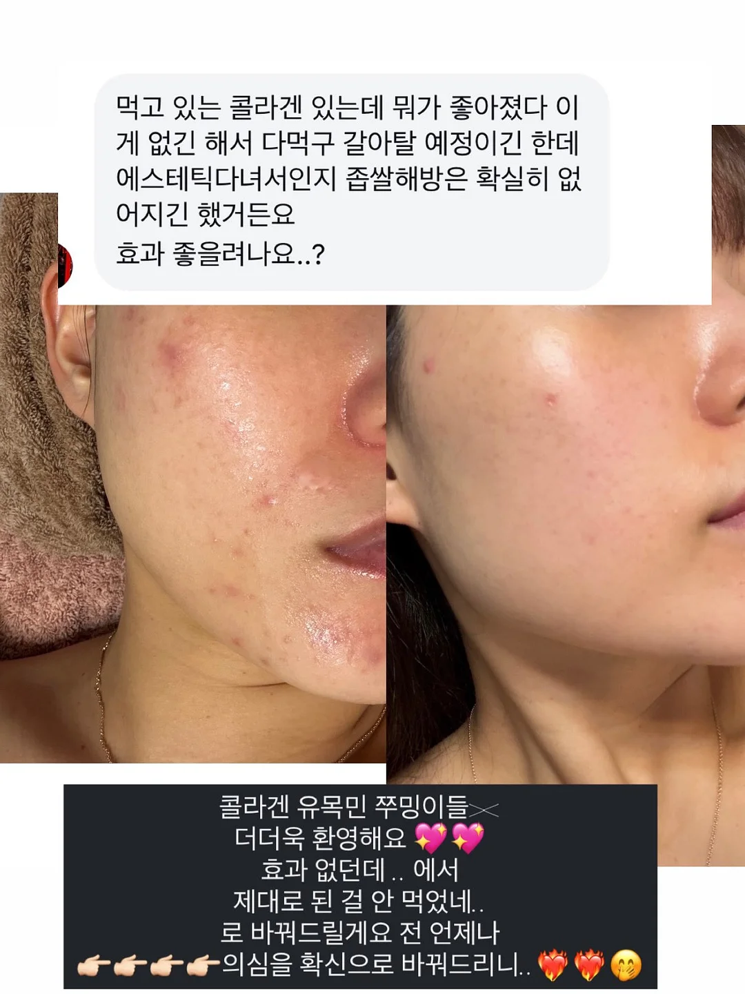 입술 문신 시술 13