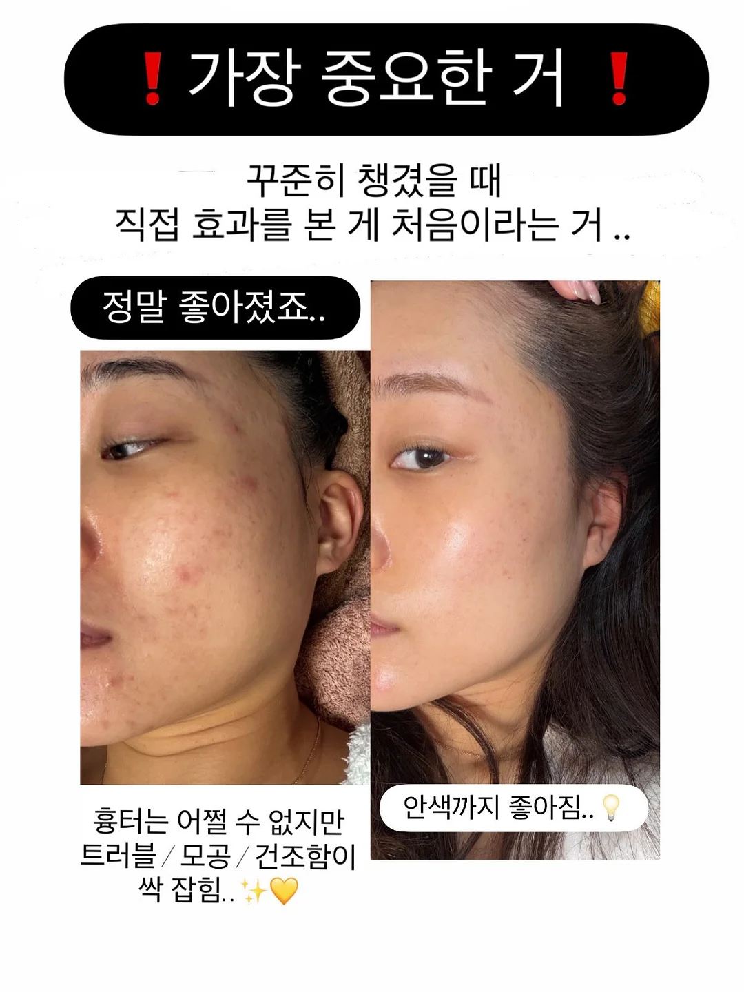 입술 문신 시술 20