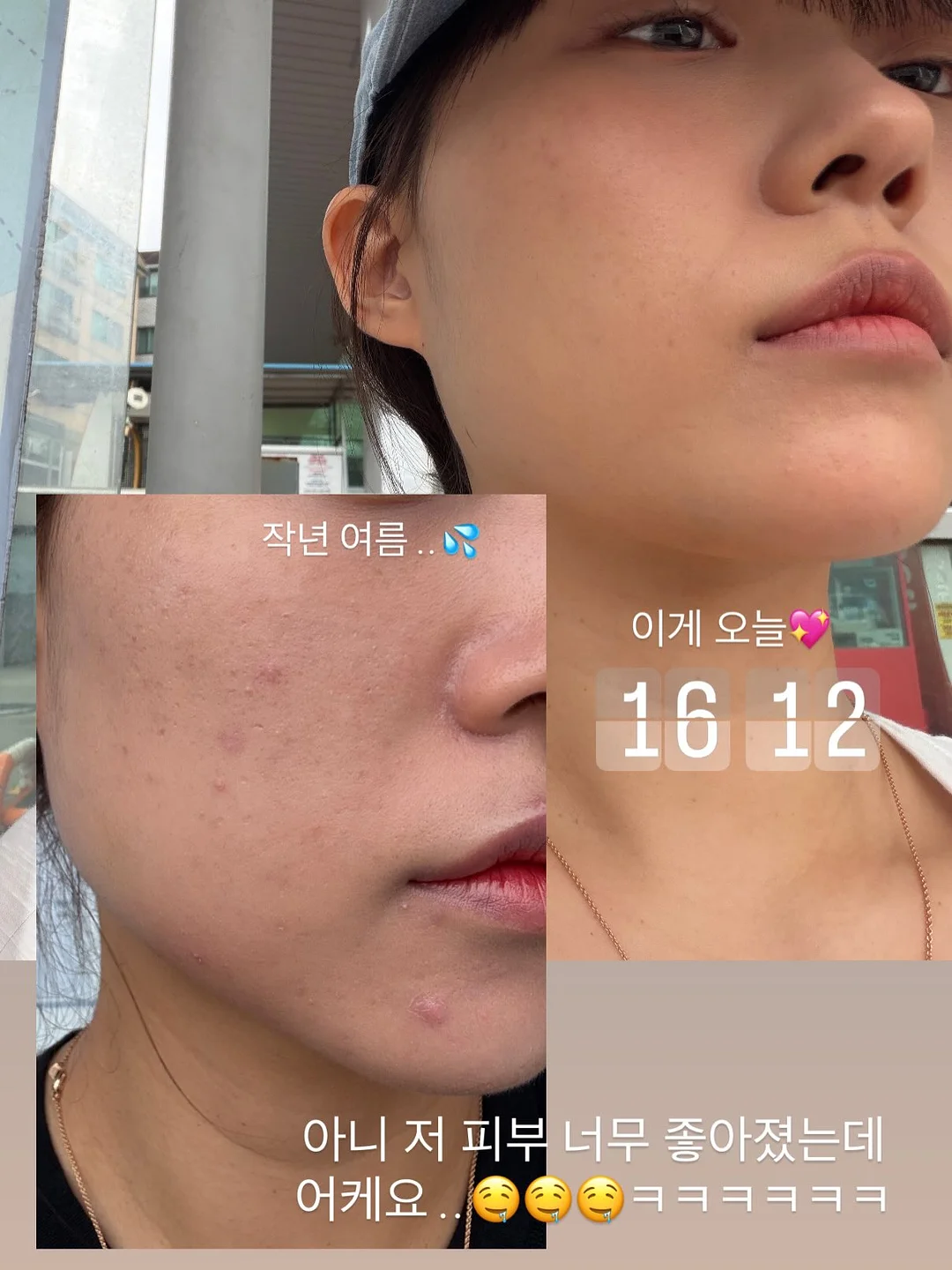 입술 문신 시술 5