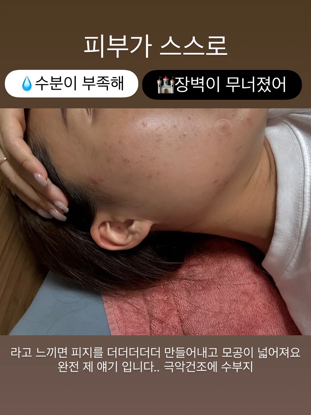 입술 문신 시술 10