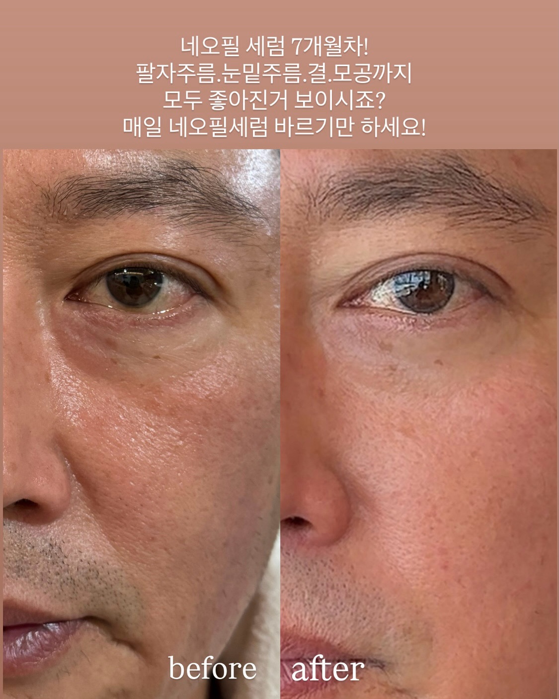 폰스트랩 4