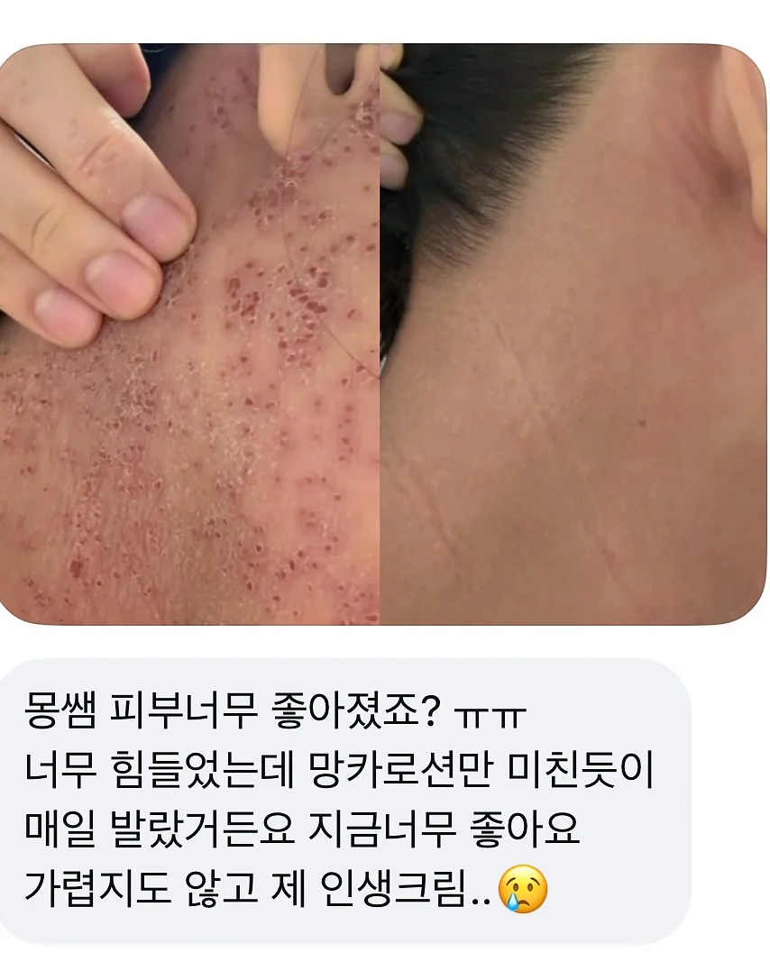 탈모템 1