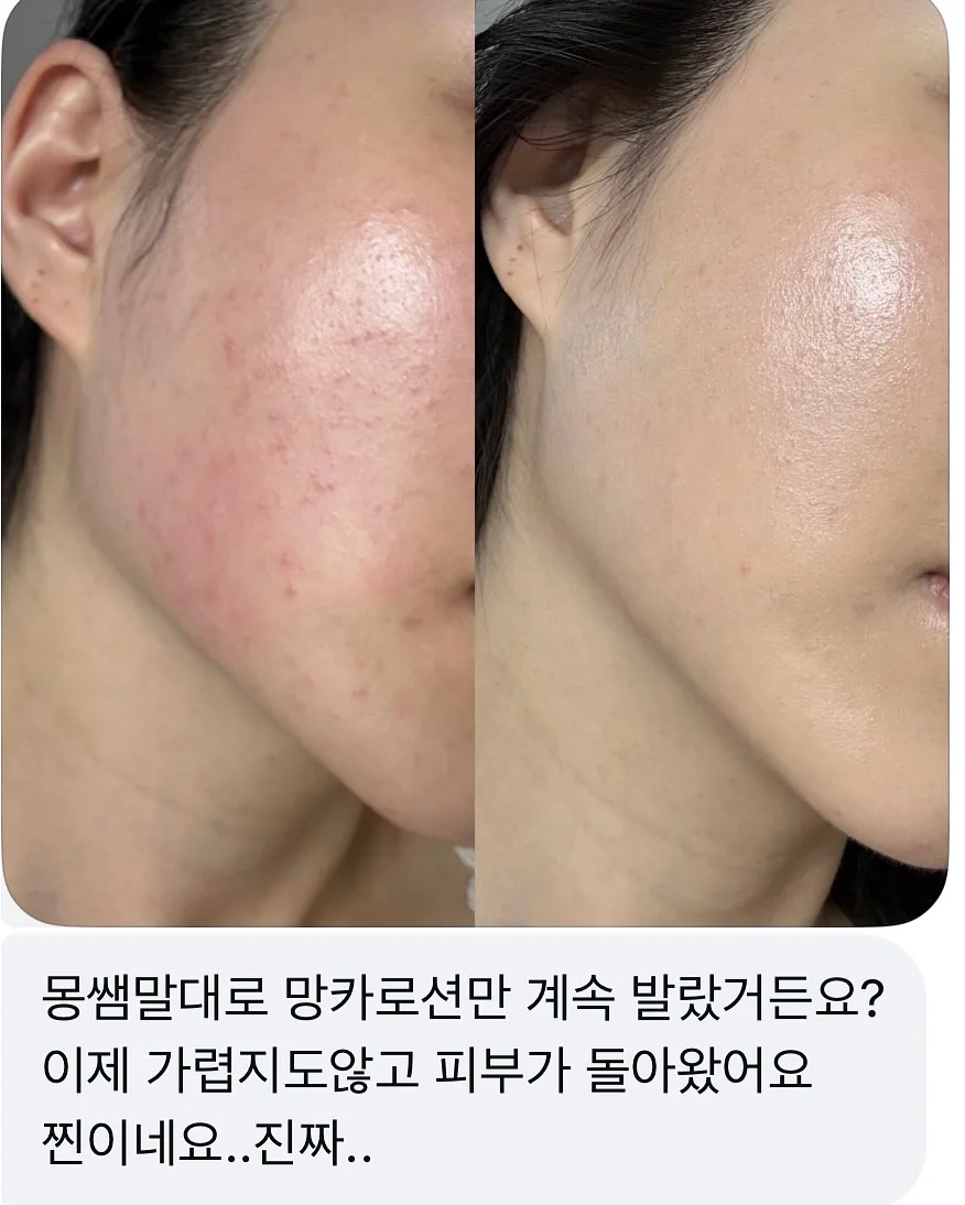 탈모템 2