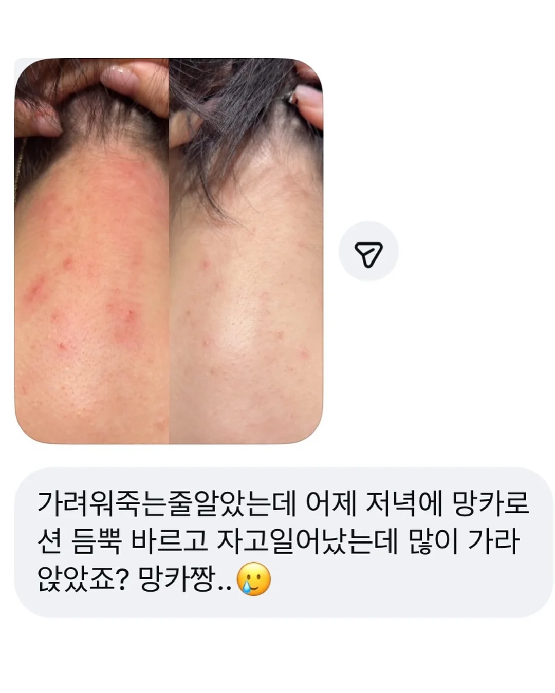 탈모템 3