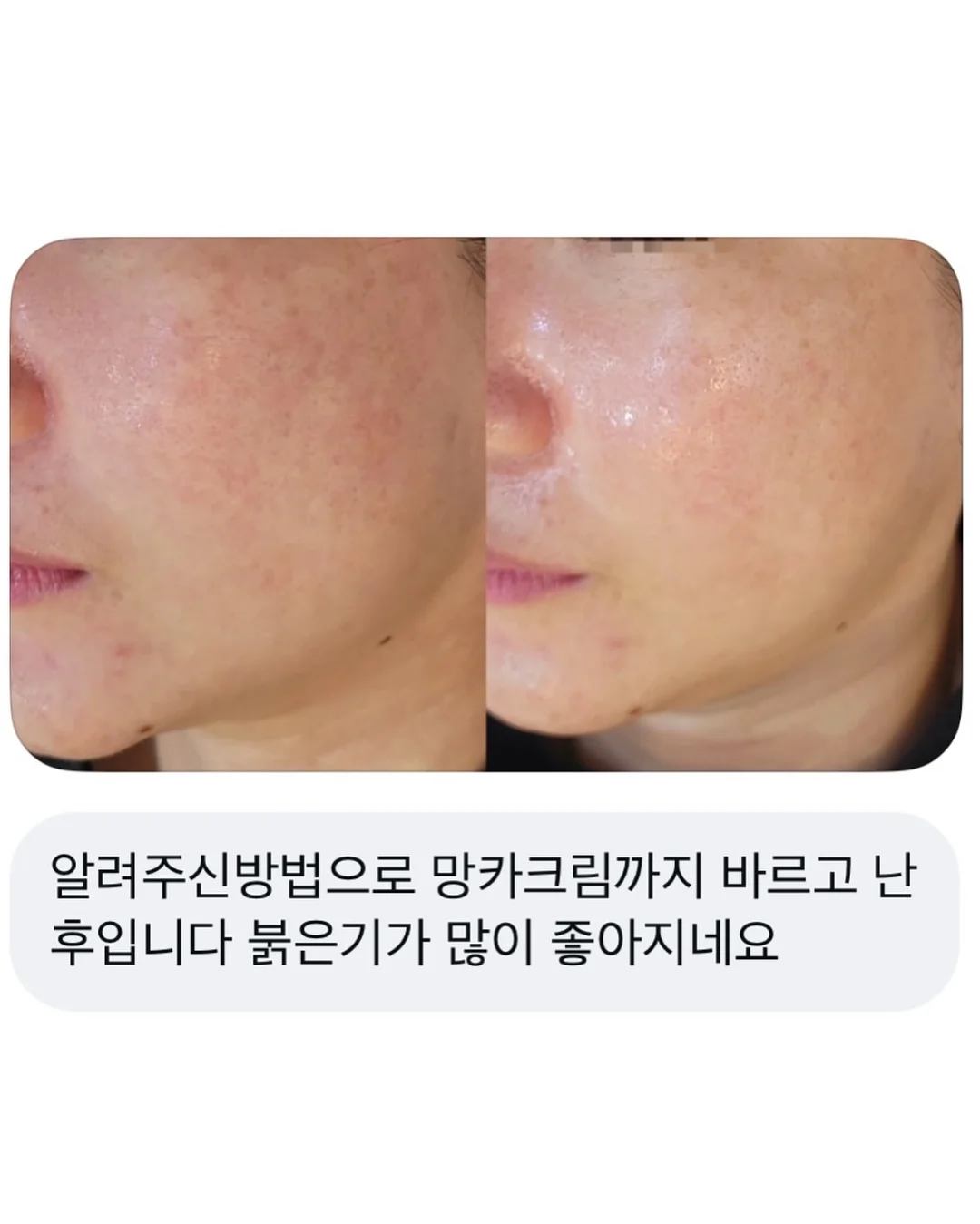 탈모템 4