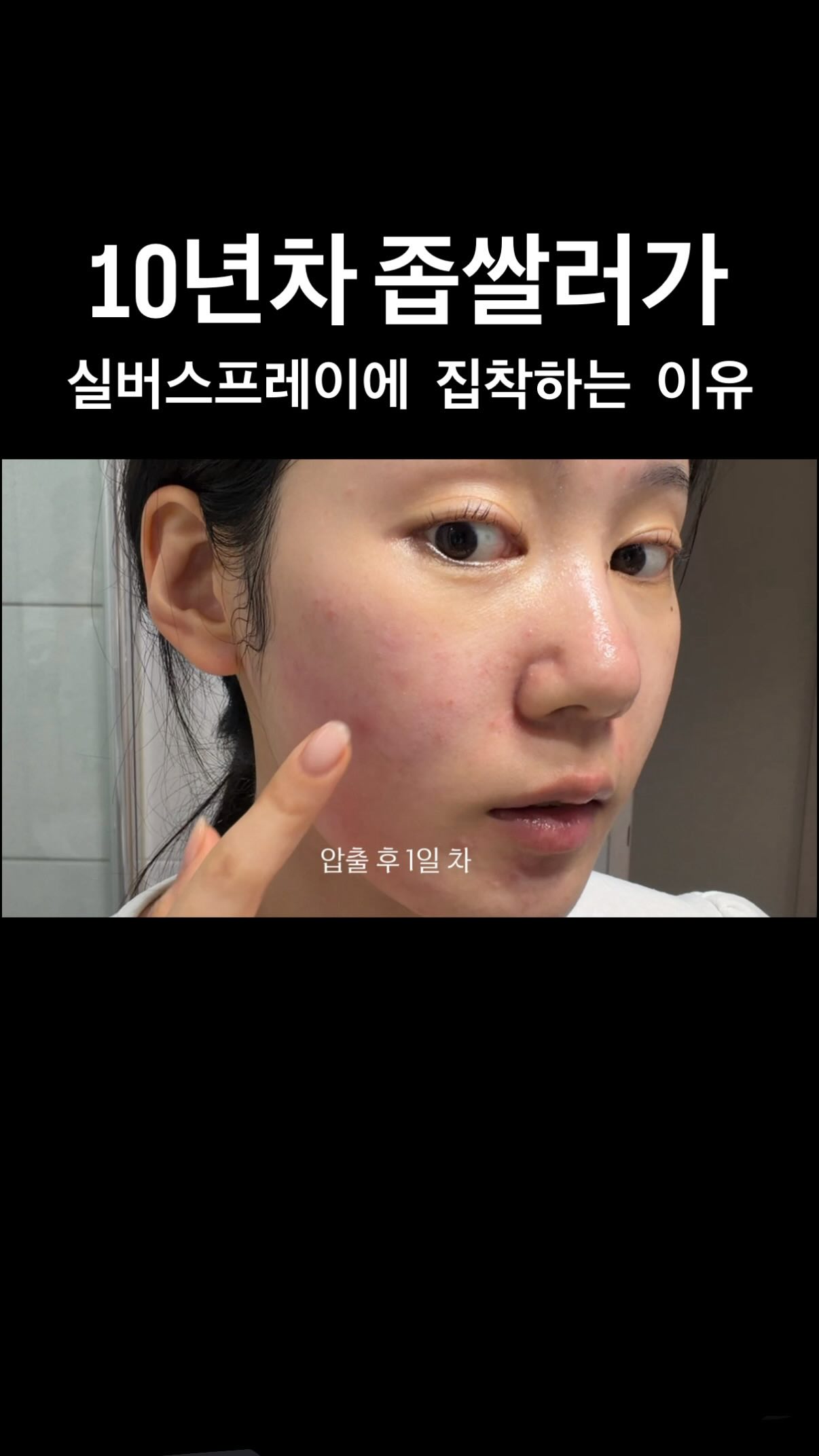 임플란트 치아레진