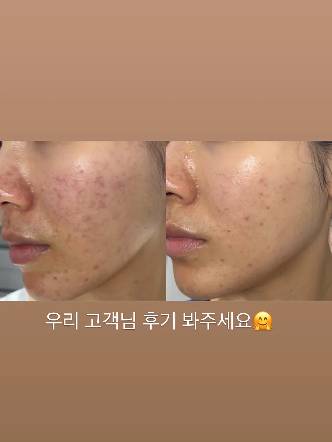 토퍼 부자재 3