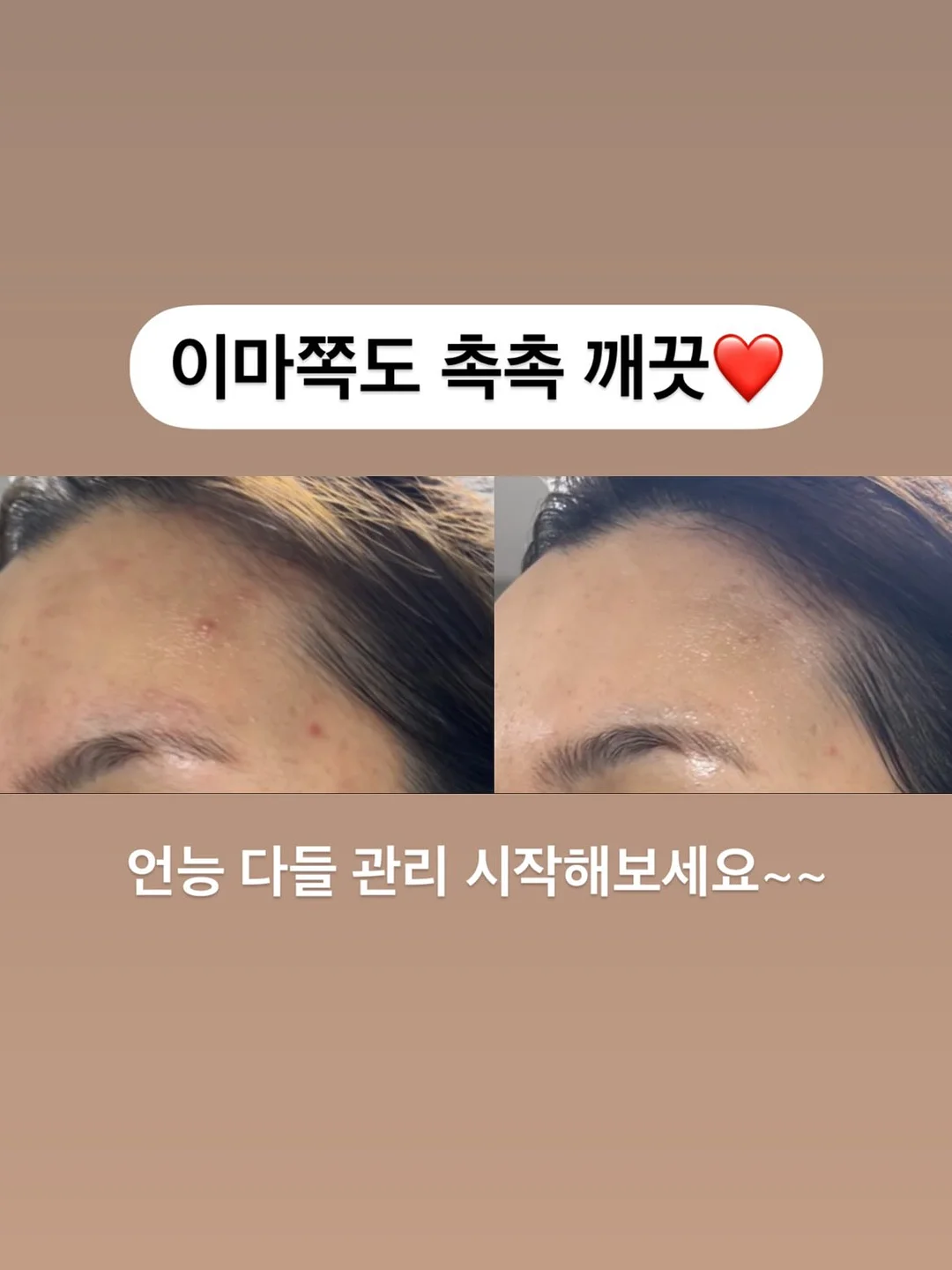 토퍼 부자재 4