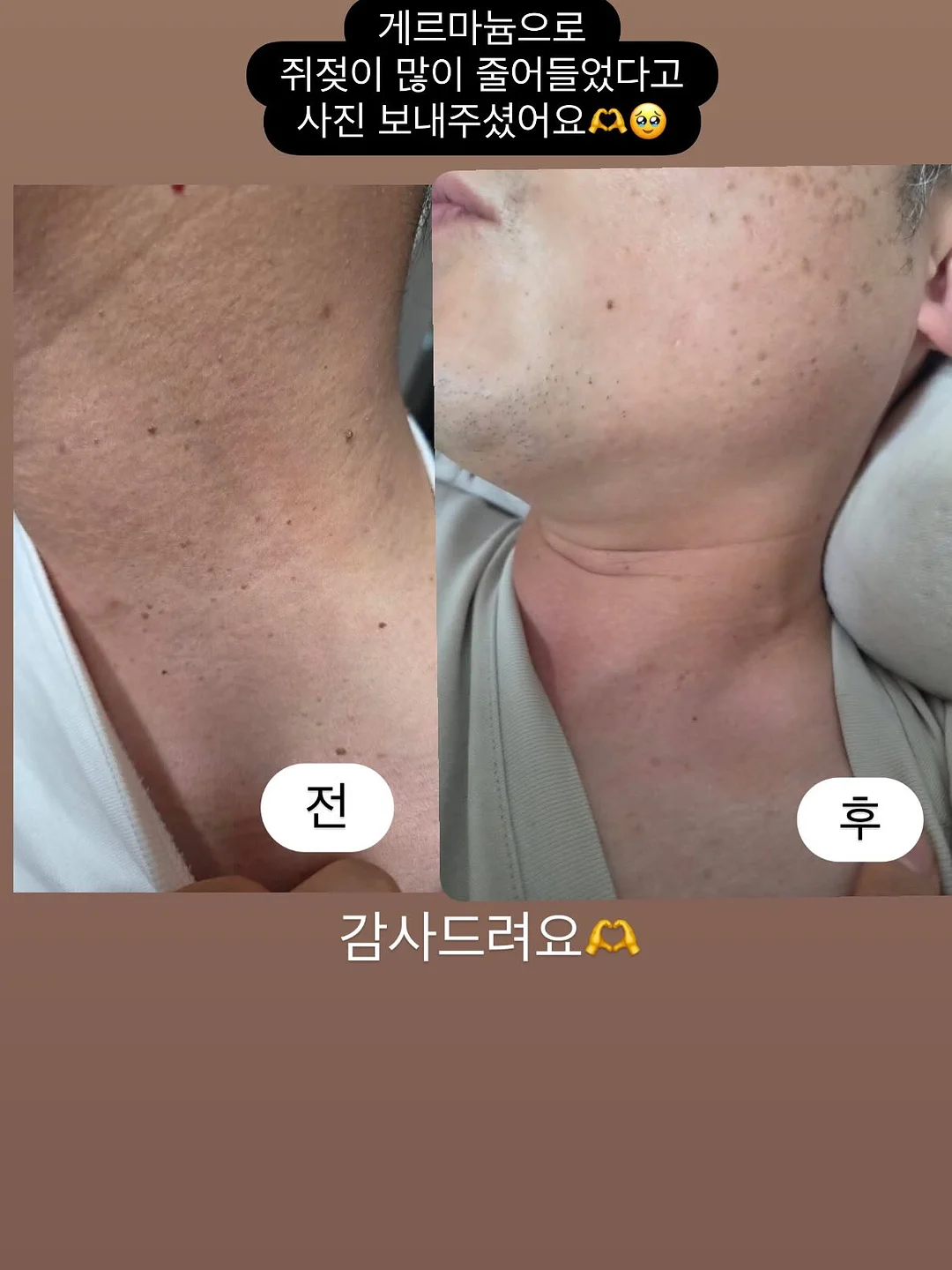 메디인랩 A3 앰플 18