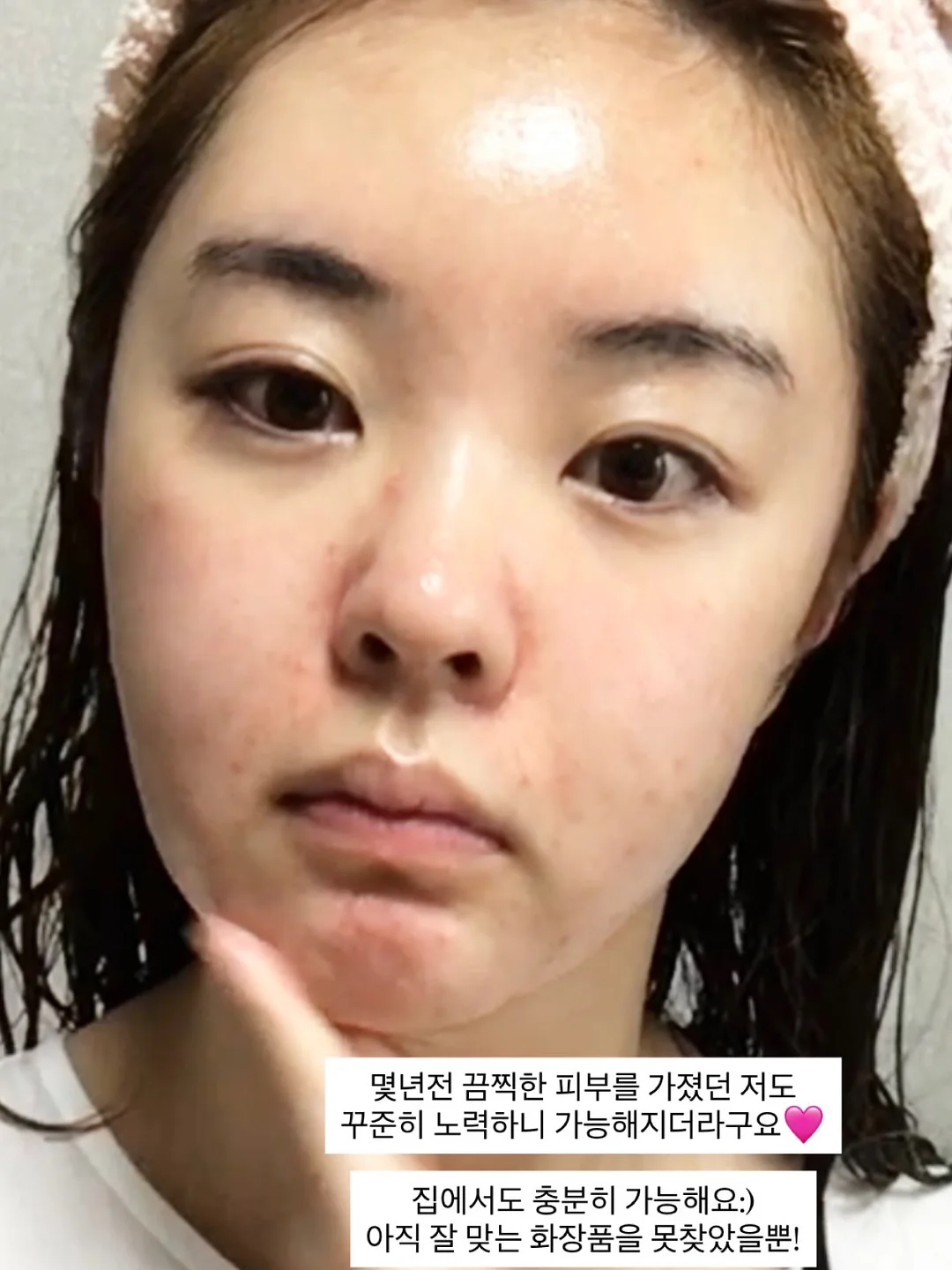 리팟 레이저, 줄기세포, 리투오 시술 4