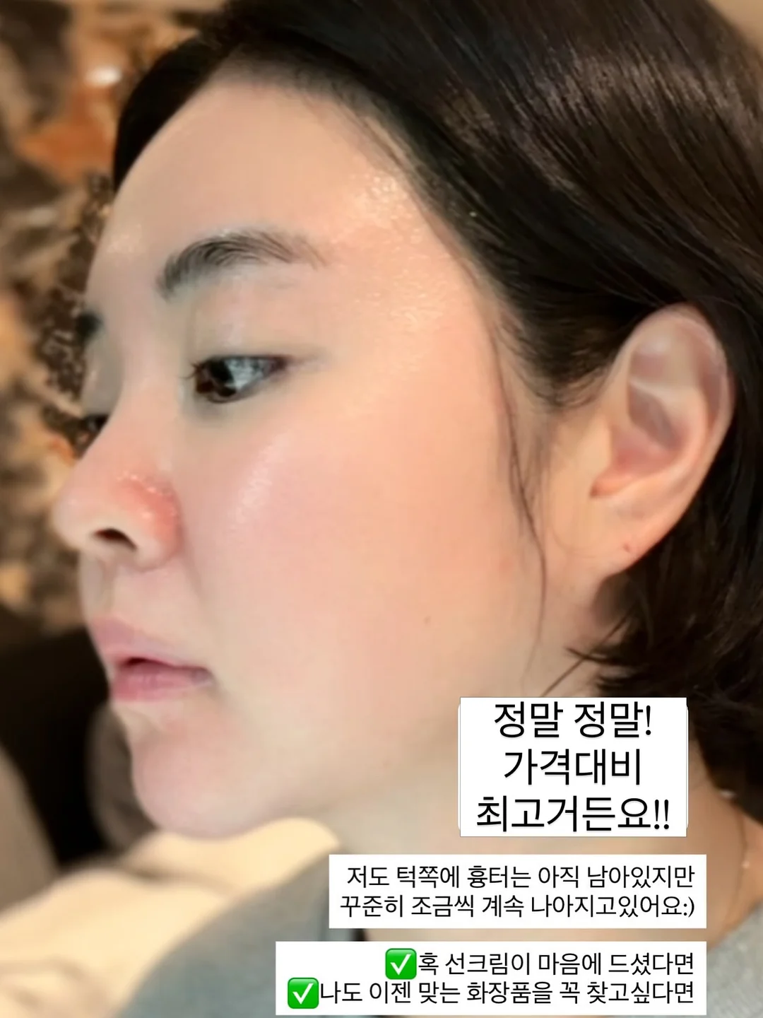 리팟 레이저, 줄기세포, 리투오 시술 5