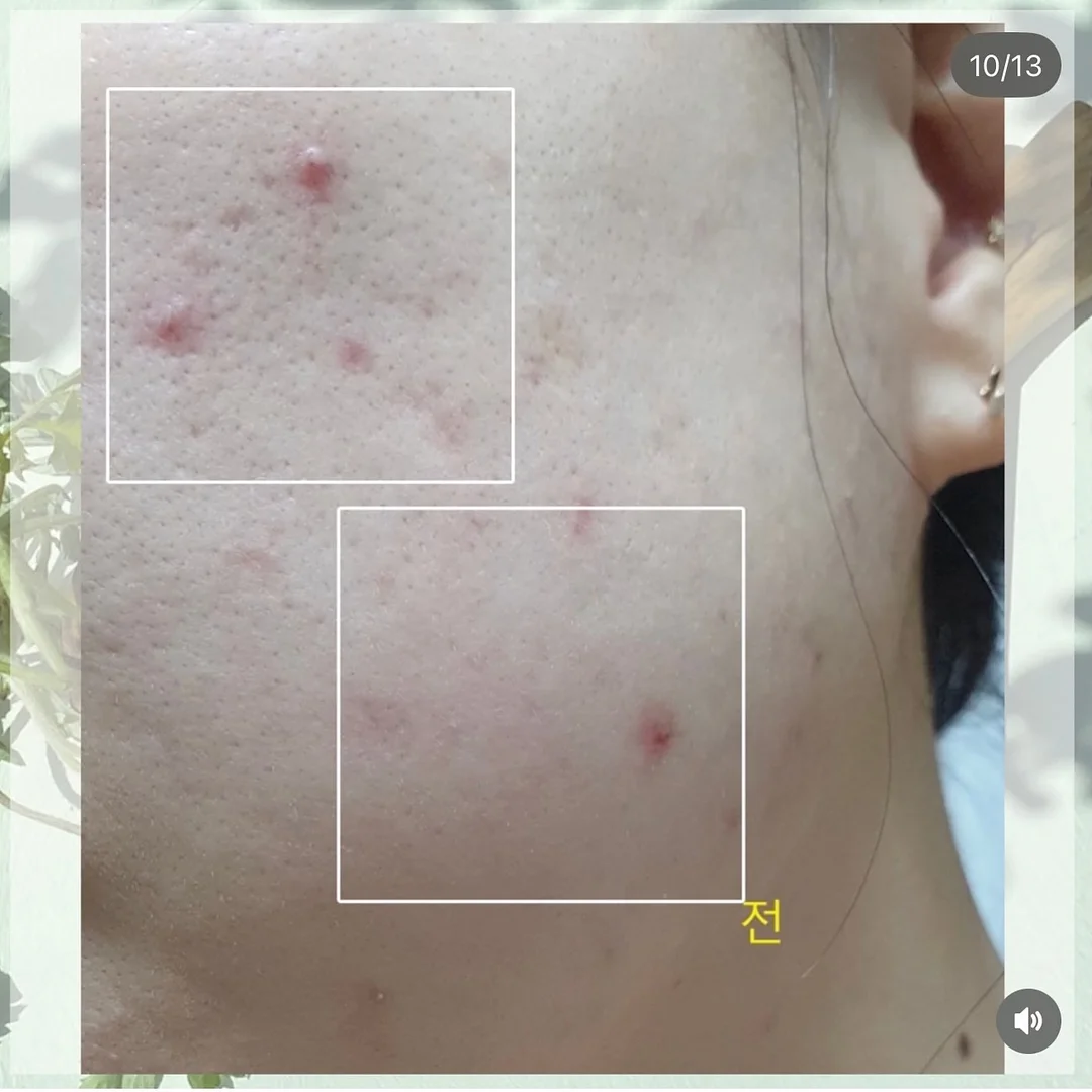 엑소메라 미백세럼 + 미백크림 10