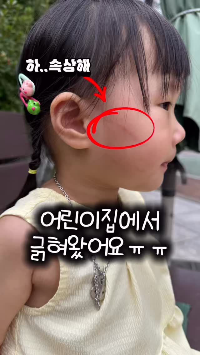 트로이 재생술 임상
