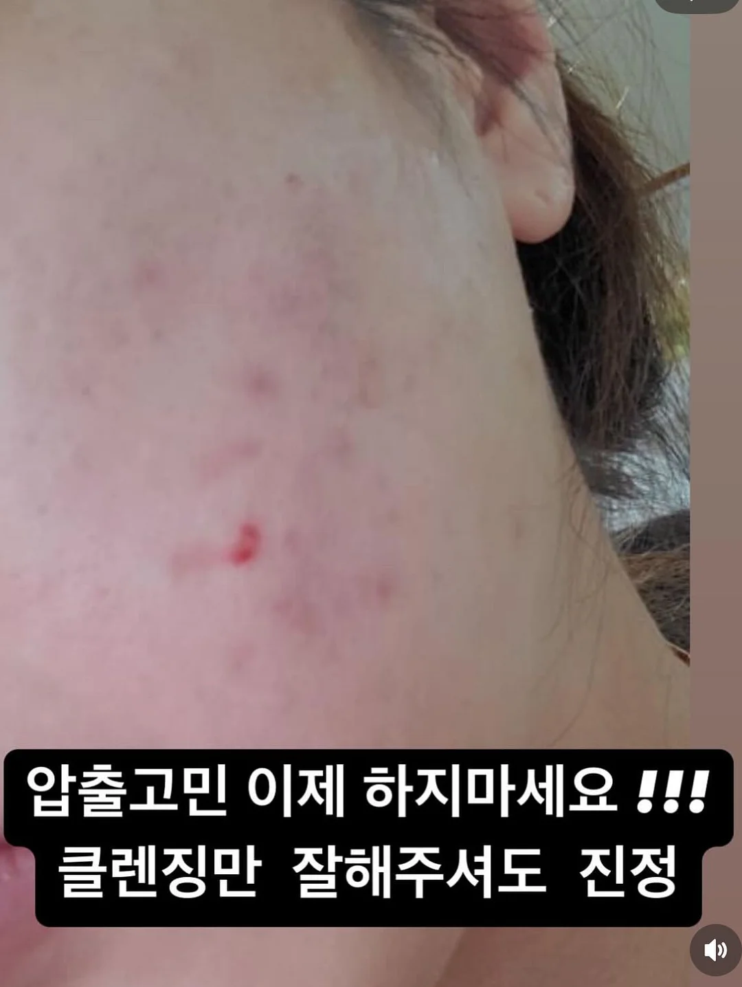 히퍼 4종 11