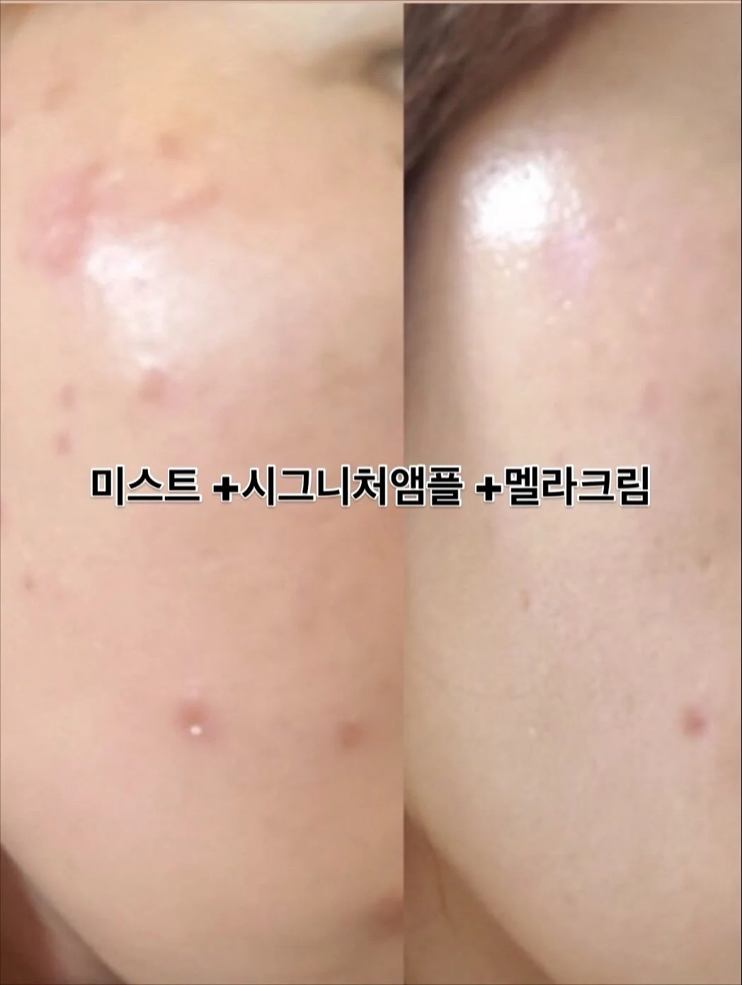 히퍼 4종 8