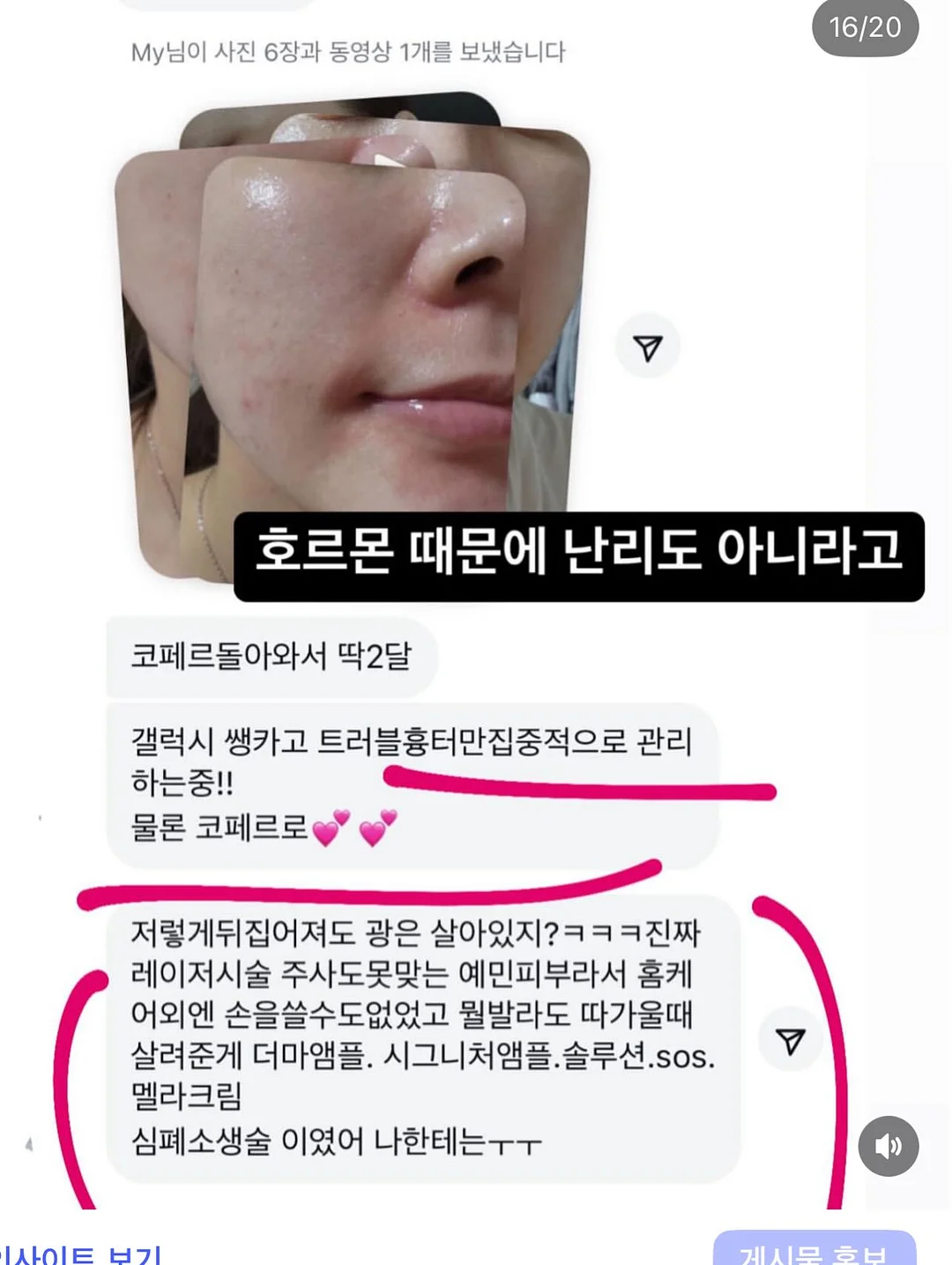 히퍼 4종 10