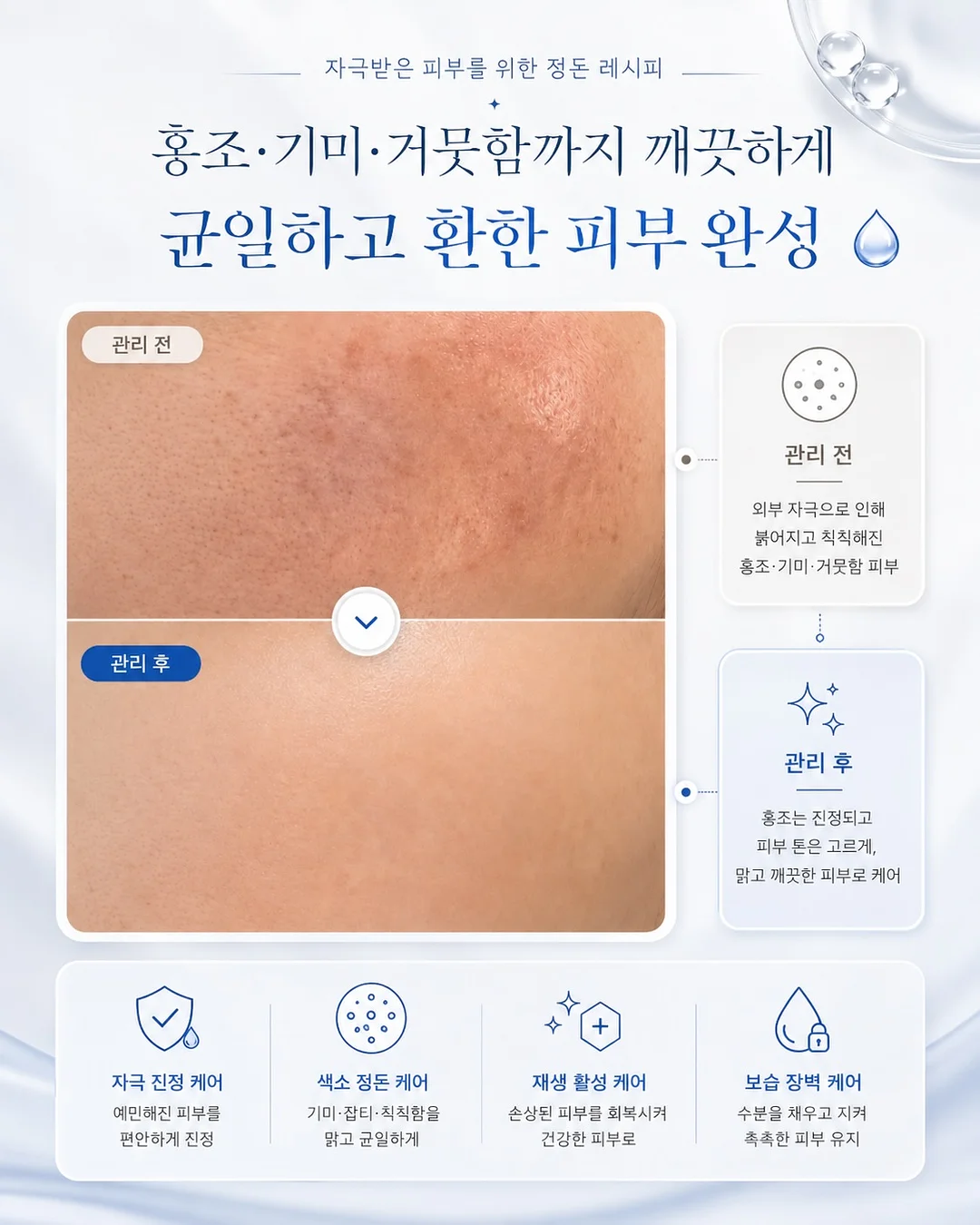 필오프 베이스 시술 4