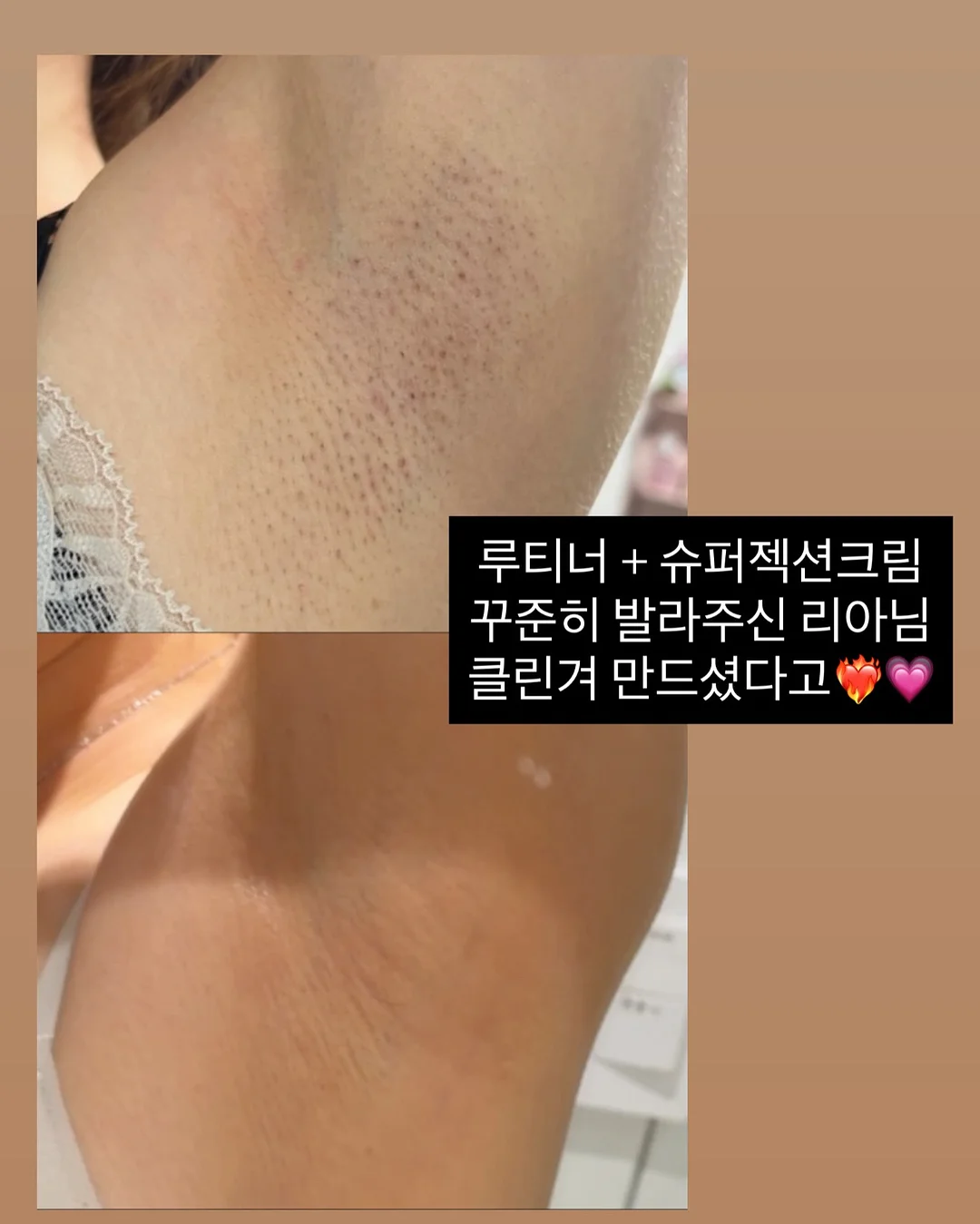 필오프 베이스 시술 6