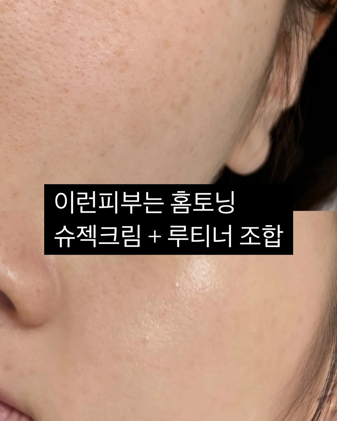 필오프 베이스 시술 7