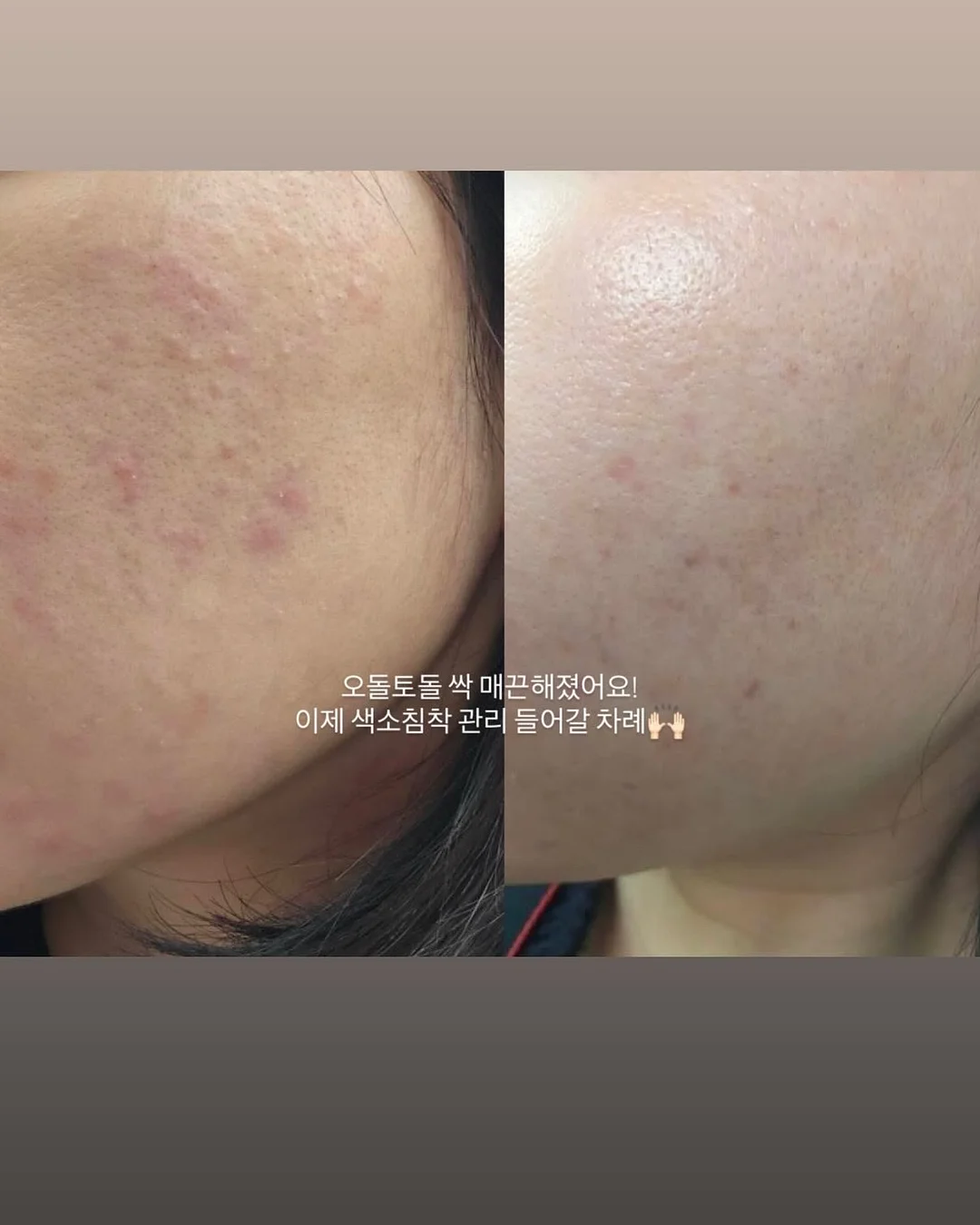 아기 머리핀 13