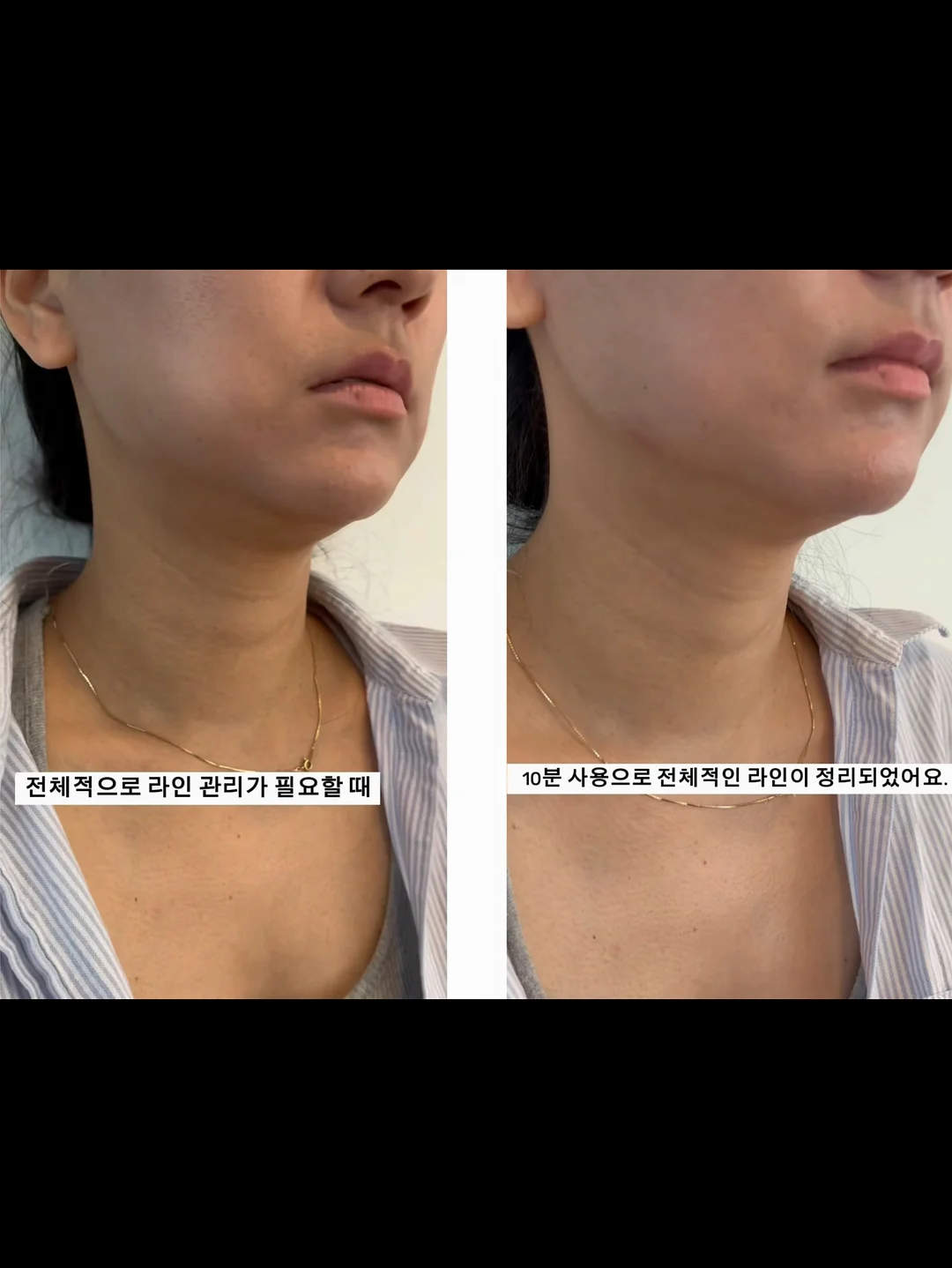 비너스 주사 5