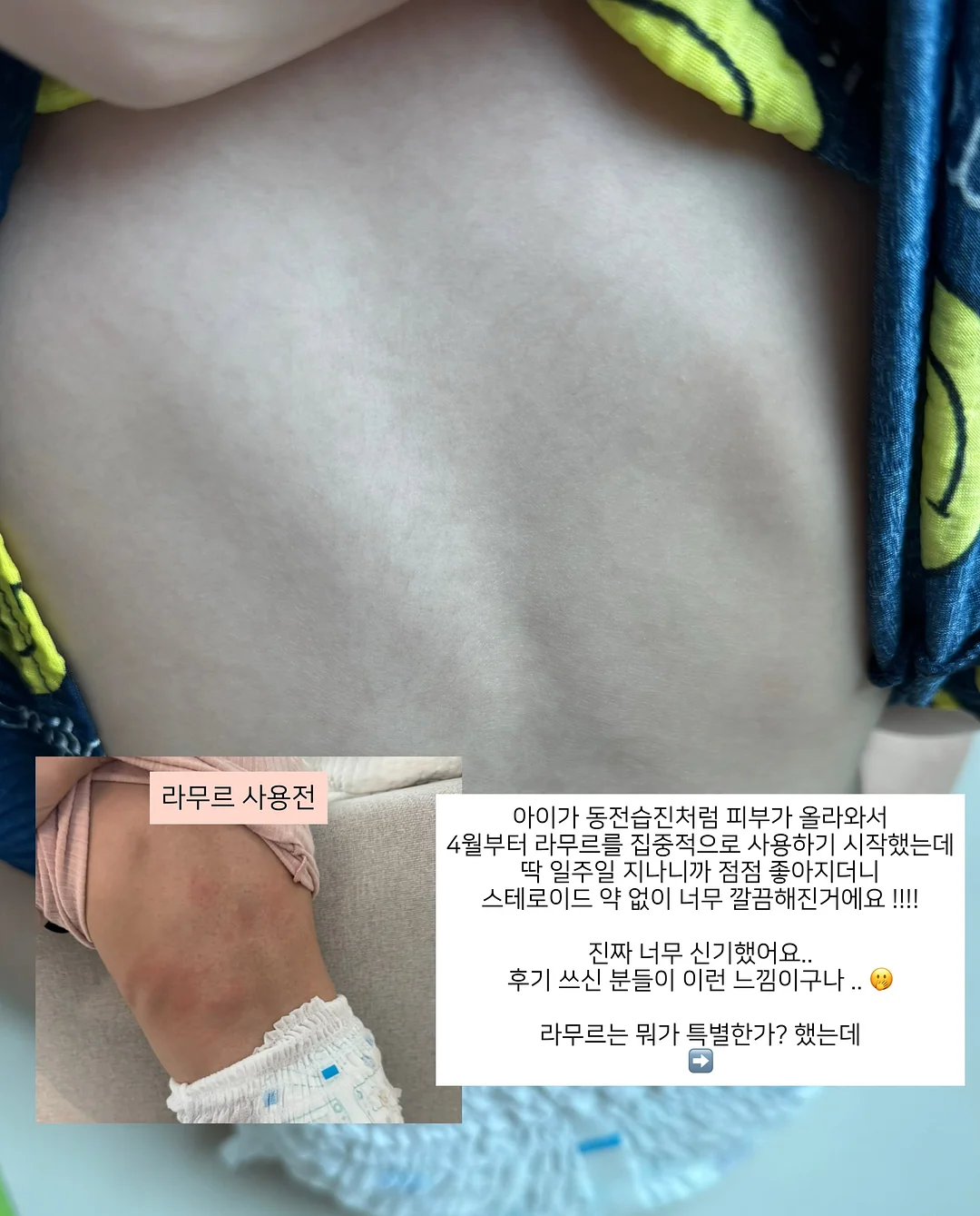 두피 스케일러, 가운, 인그로운 스크럽, 착색 토너, 등드름 미스트 4