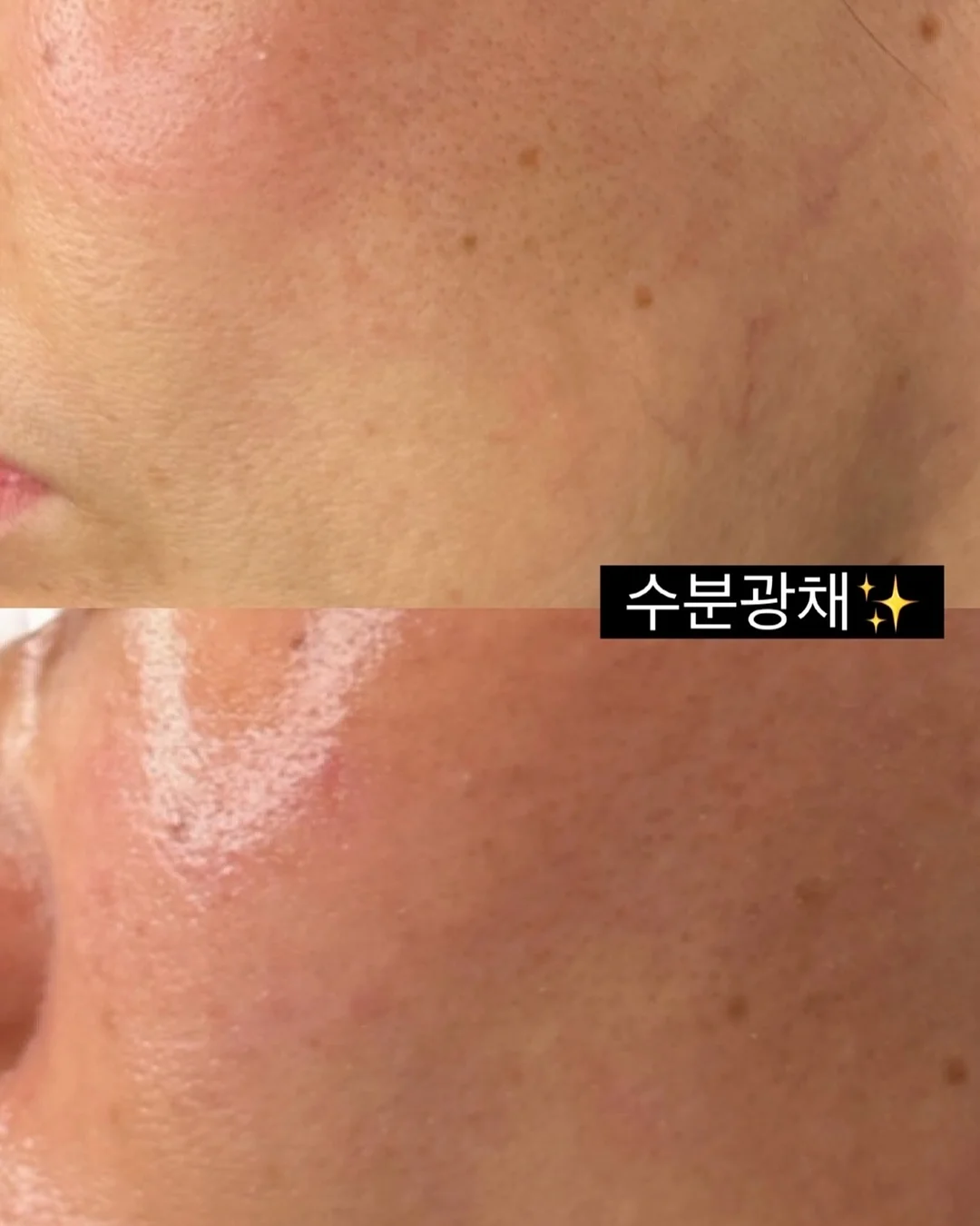가슴성형 비용 8