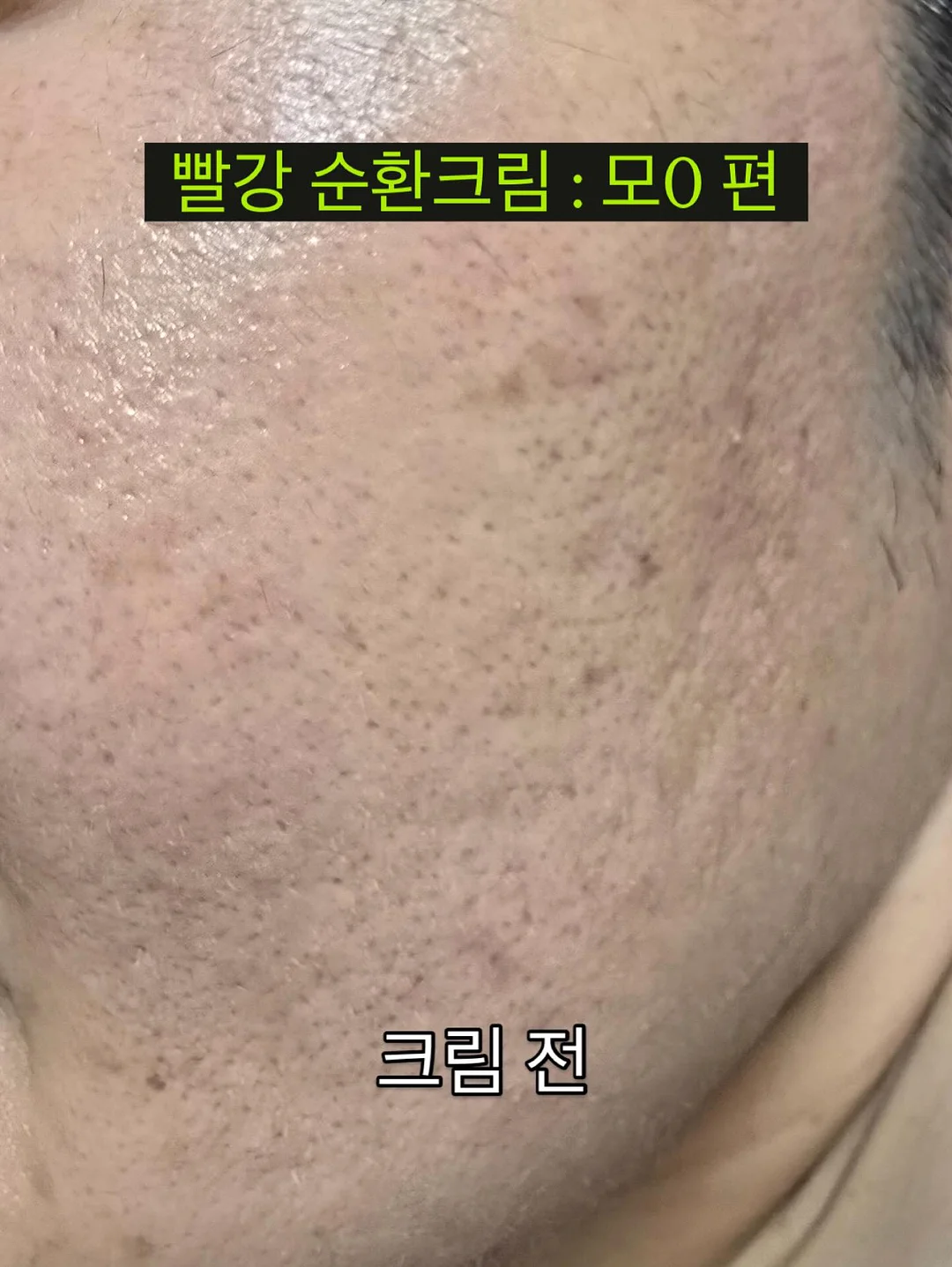 보톡스 4