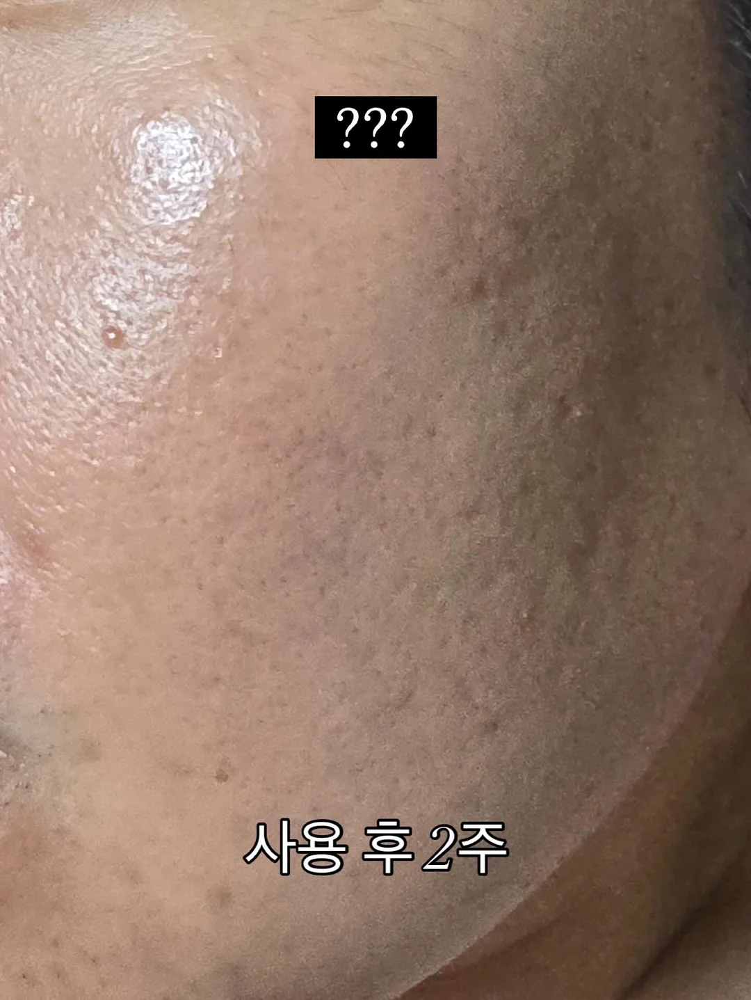 보톡스 5