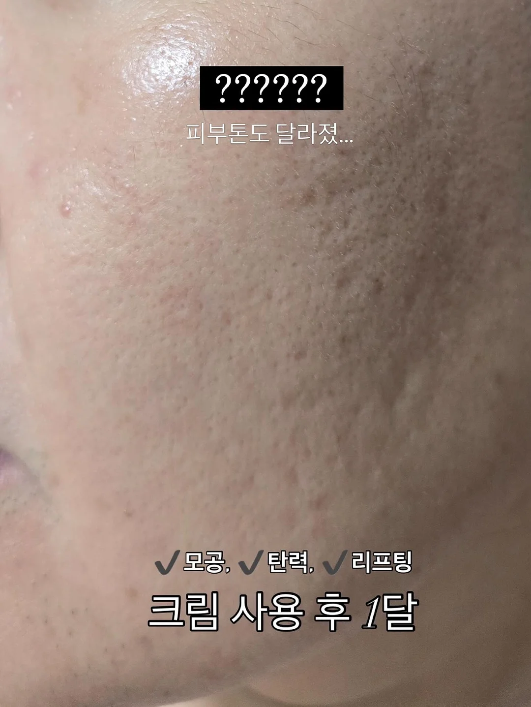 보톡스 6