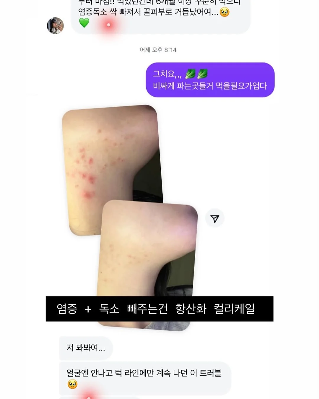 마점 숱채움 시술 10
