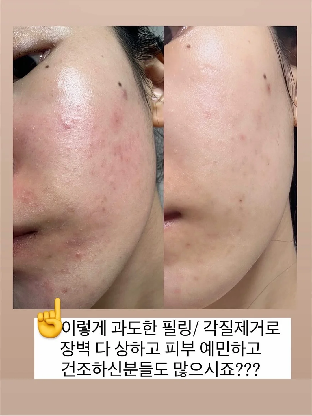 붙임머리 5
