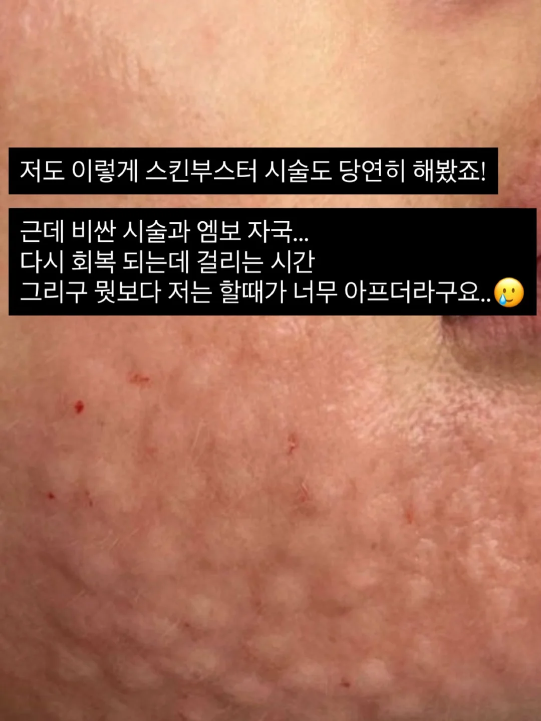 조이키토 방광 수비 레시피 3