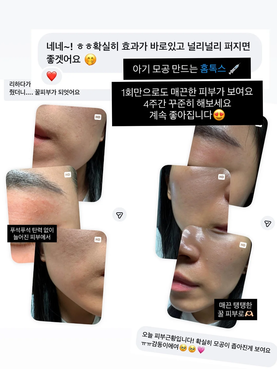 전신돔, 하프돔 5