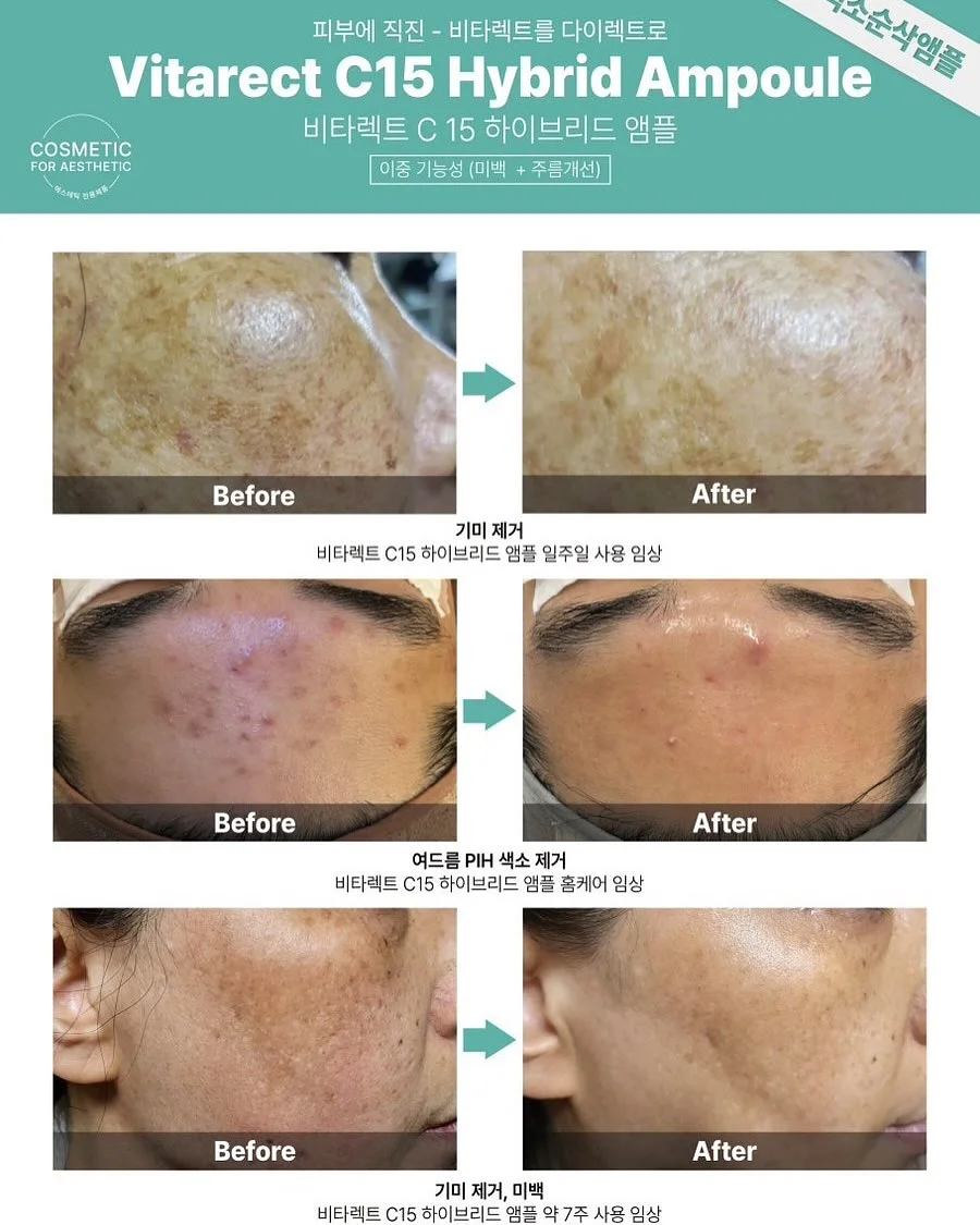 보그백 15