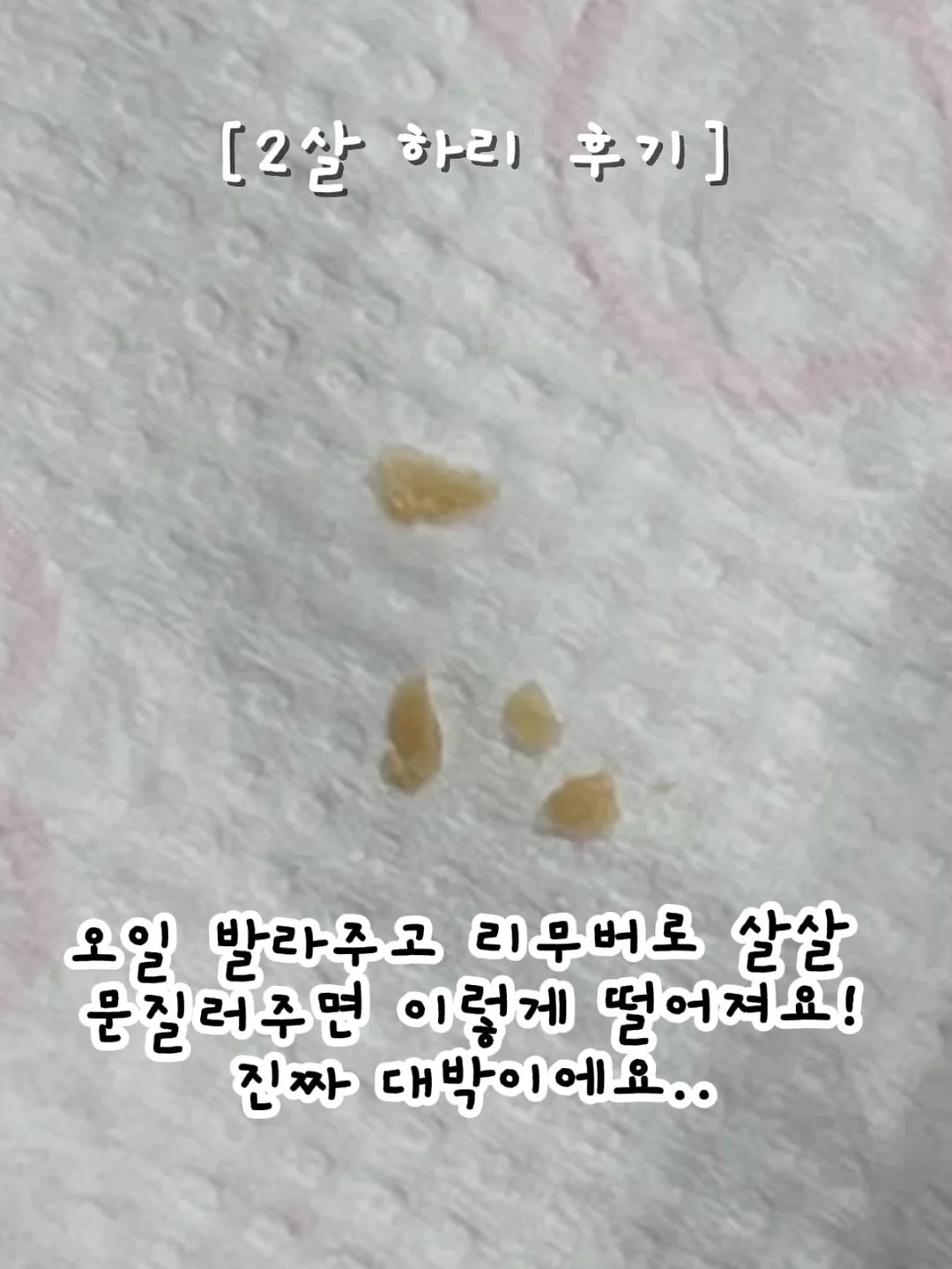 모공주사 홈케어 5