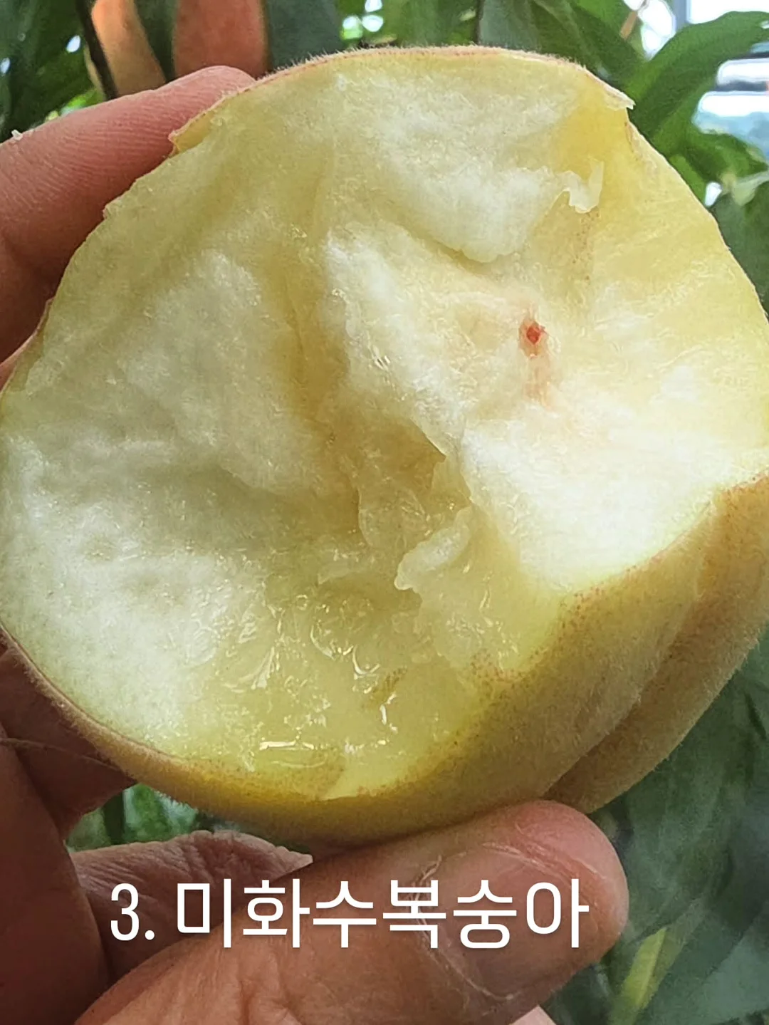 리프팅 시술 6