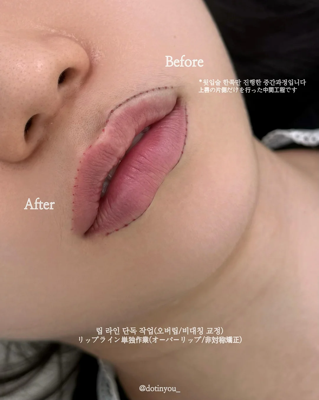 발목 테이핑